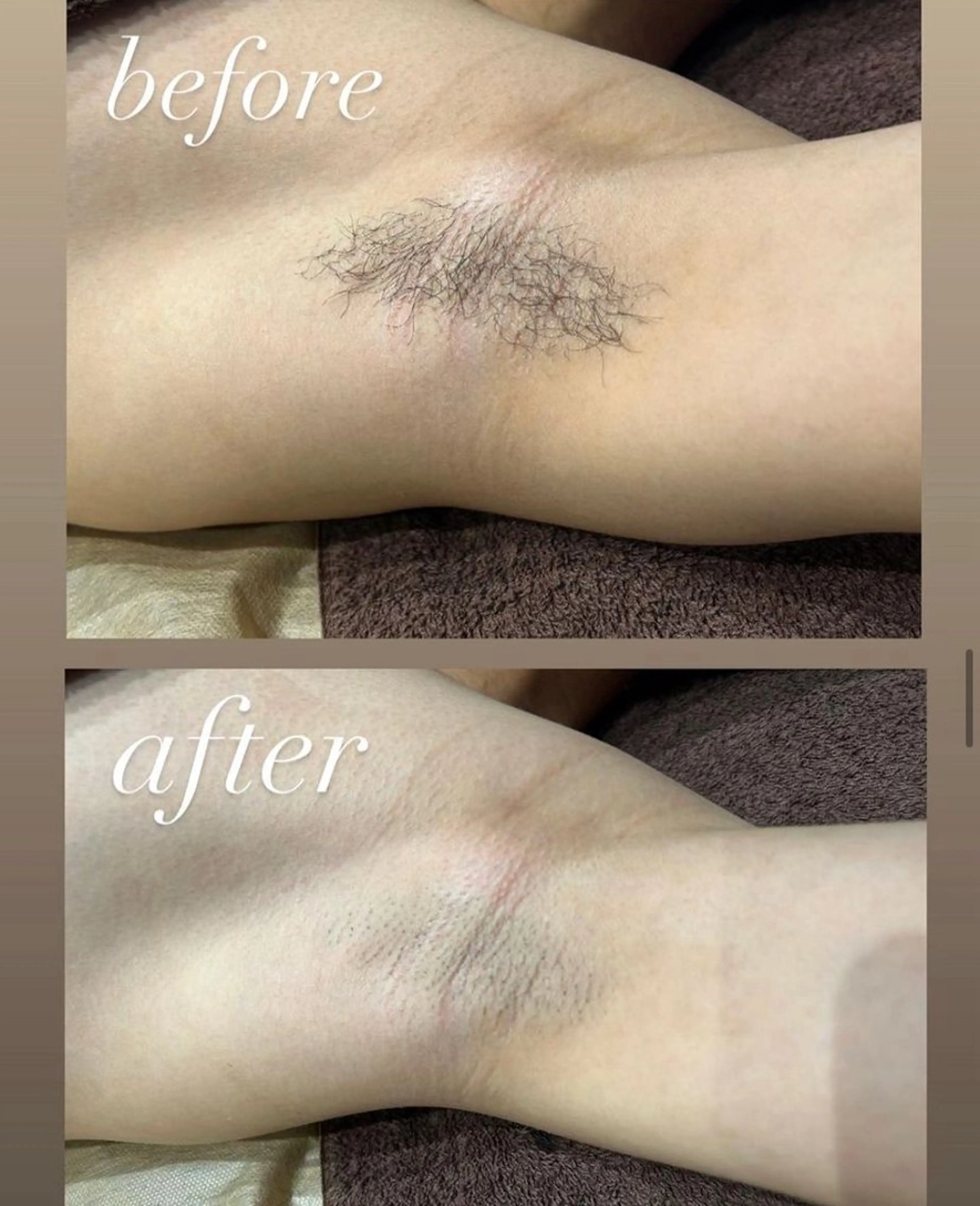 学生様限定★ 男性も女性も◎ワキ＆腕脱毛 卒業まで何回でも3500円/回の写真