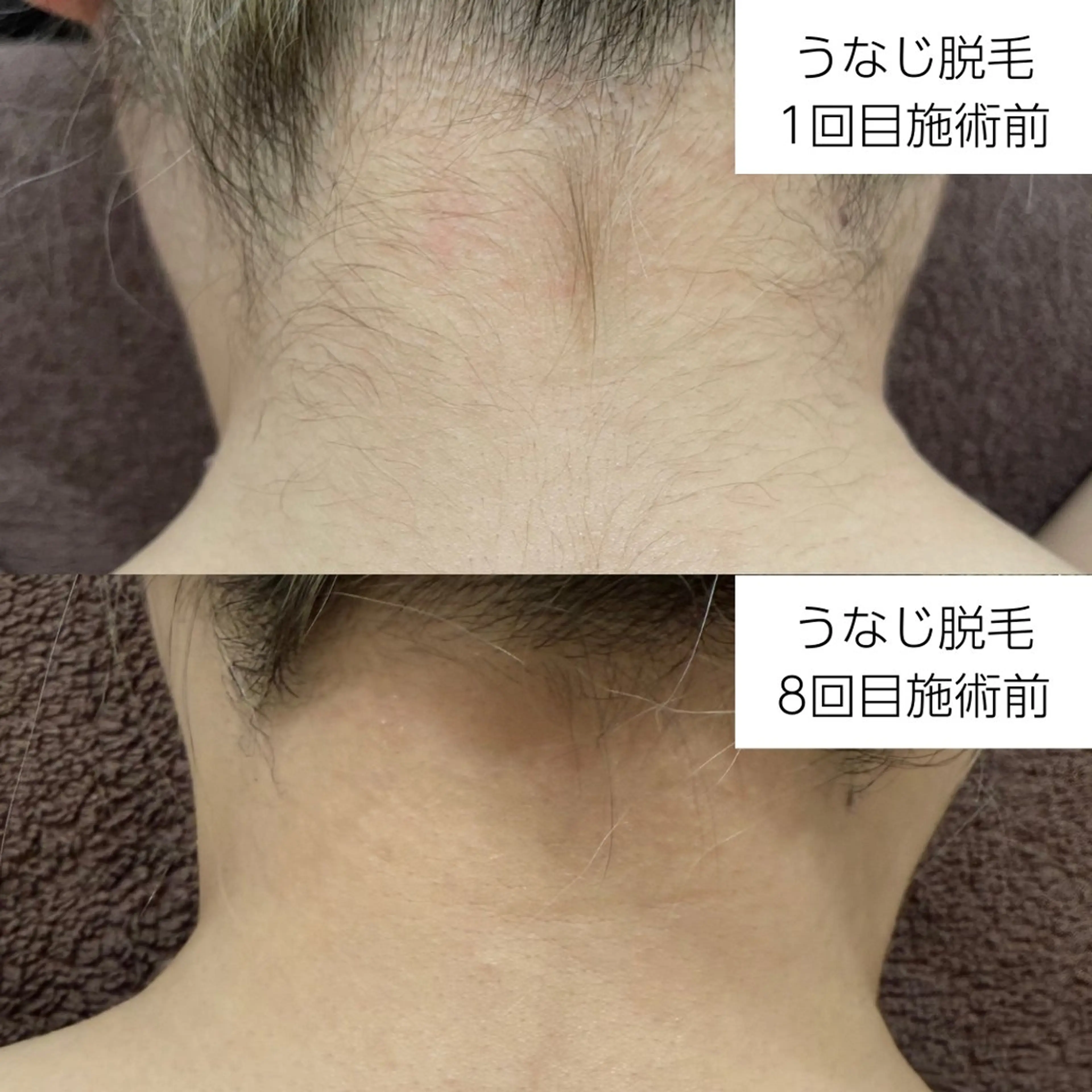 脱毛 vary  clue MISAのエステ・リラクイメージ