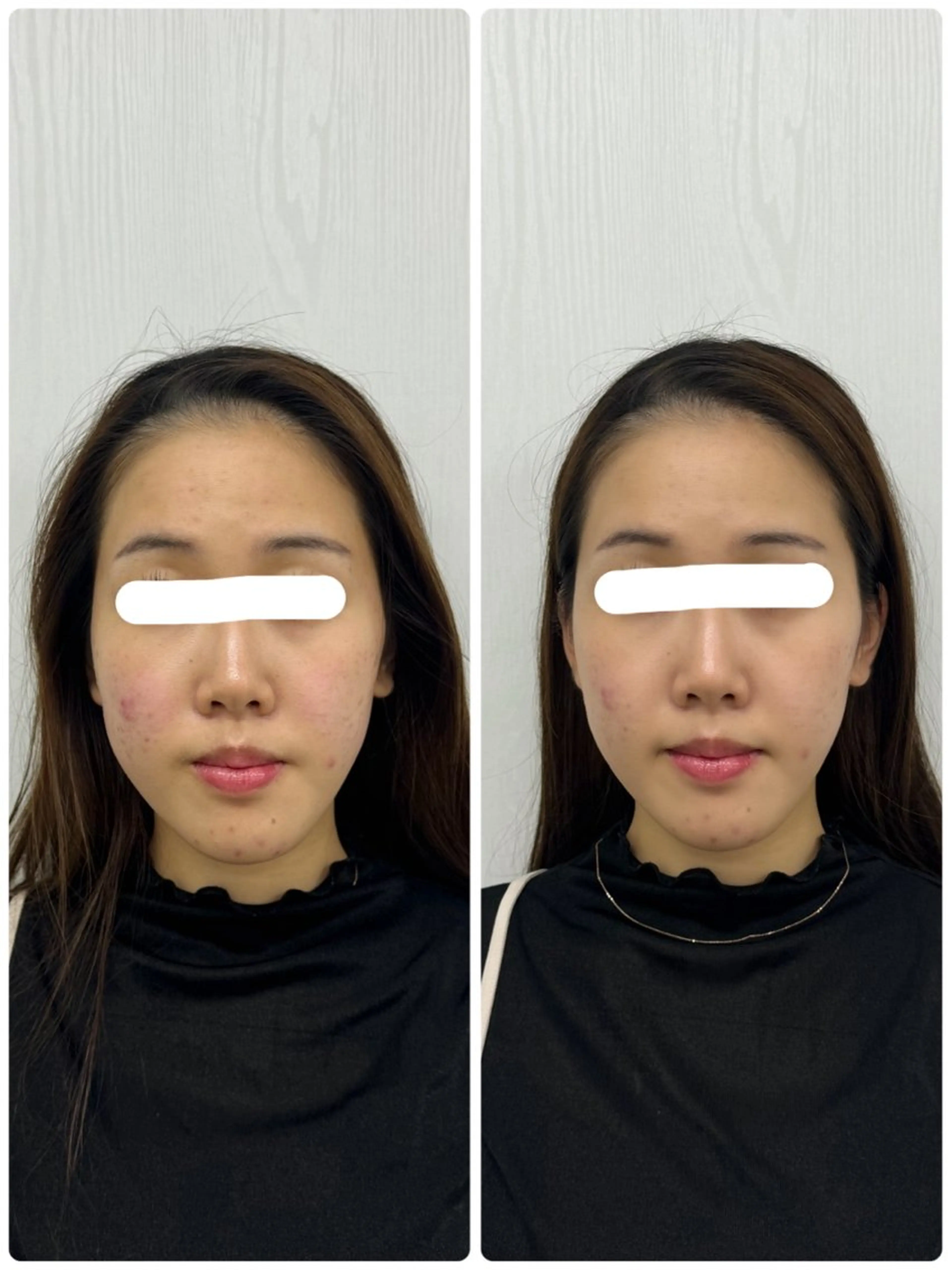 美容鍼×小顔矯正 ×美容整体　浜川泰仁のエステ・リラクイメージ