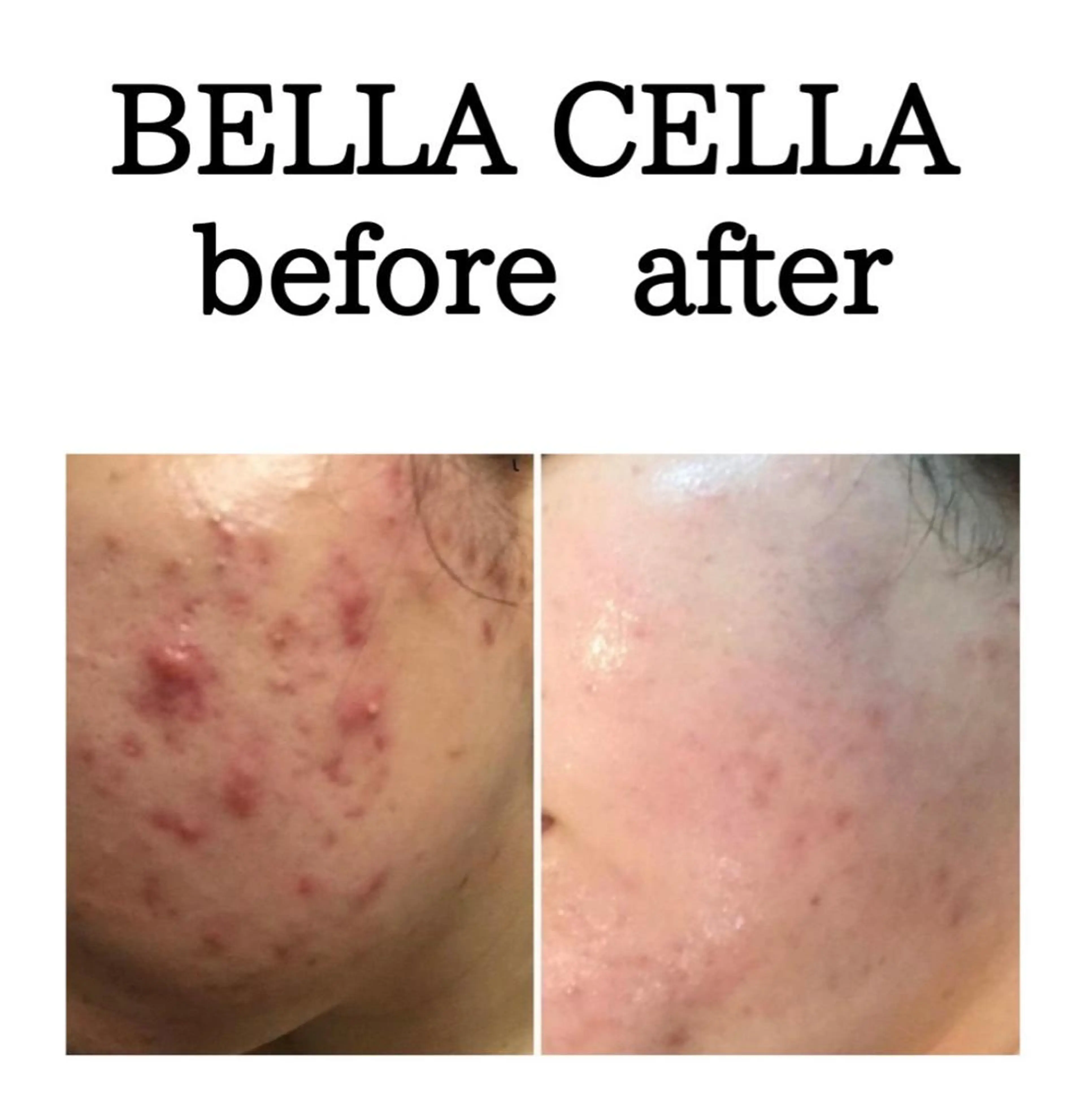 韓国クリニック美容「ベラセーラ」肌質改善を望む方はこちら。ニキビで悩む時間はもう要らないの写真