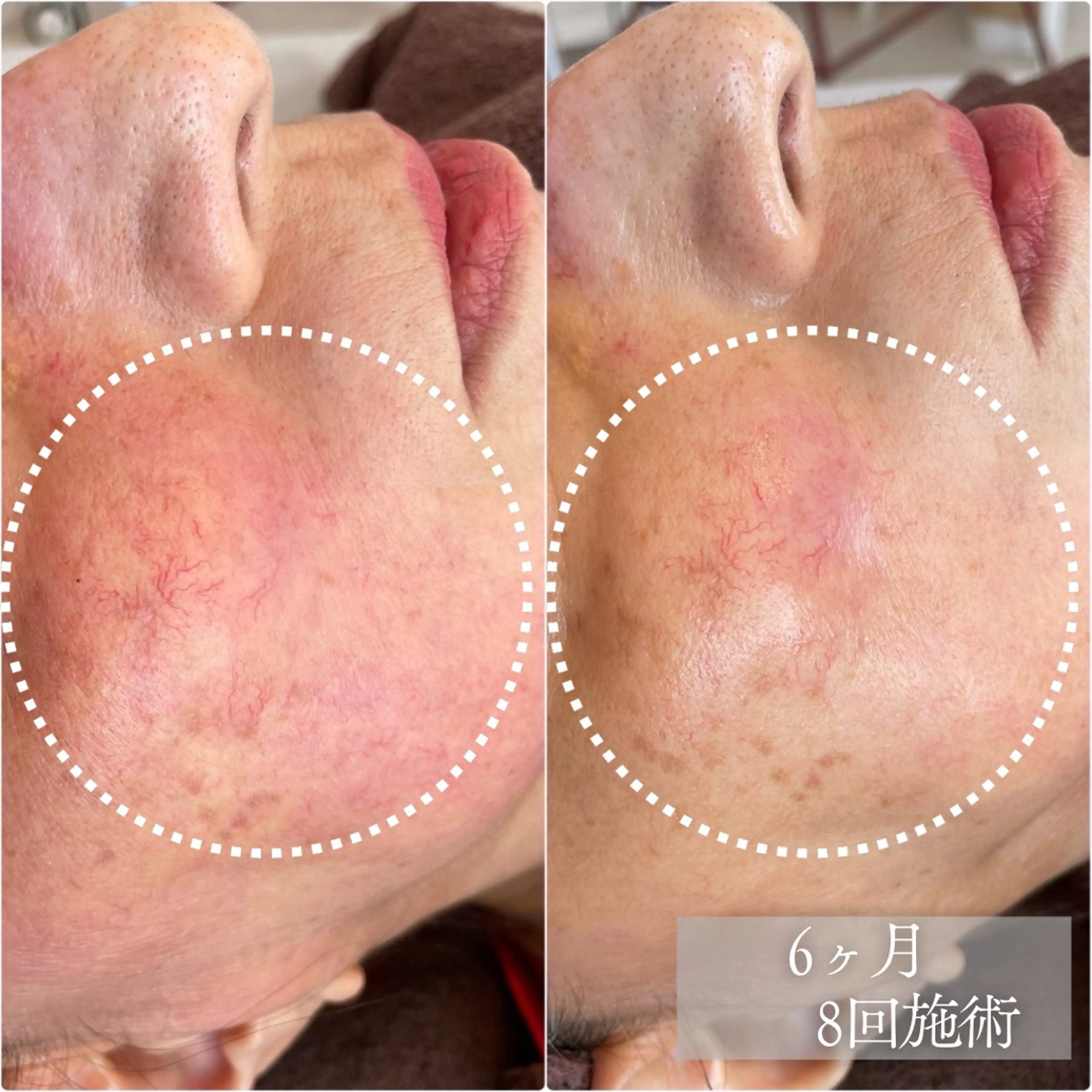 【肌荒れ•ゆらぎ肌に】艶肌ジュエリーピール＋毛穴洗浄で肌荒れケア　ヘッドスパ＆首肩デコルテトリートメント付きの写真