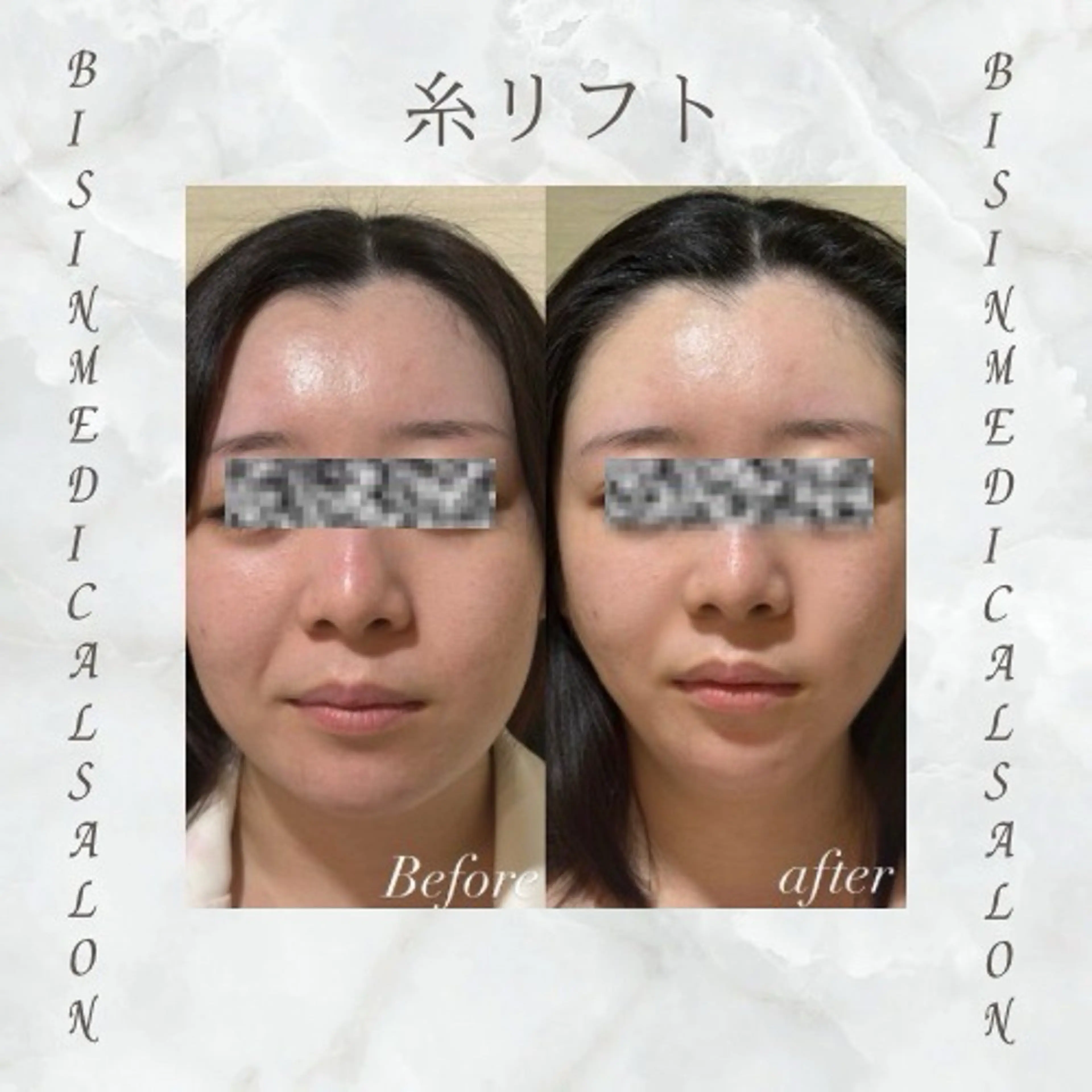 【エステ版】糸リフトの写真