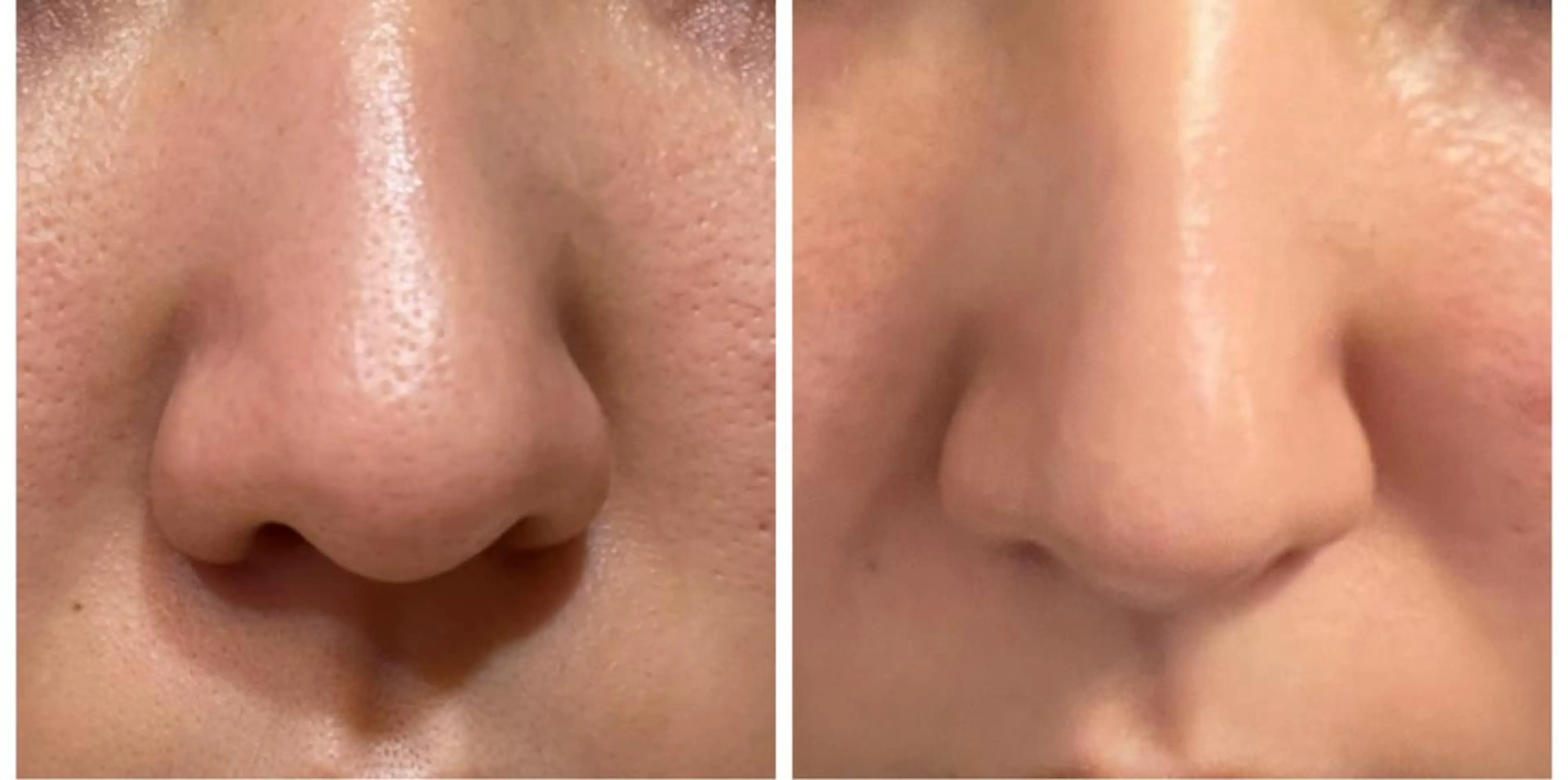 【大人気💓毛穴汚れゴッソリ洗浄✨】イチゴ鼻撃退🔥毛穴オイルアップ&スクライバー洗浄&オイルマッサージ😊の写真