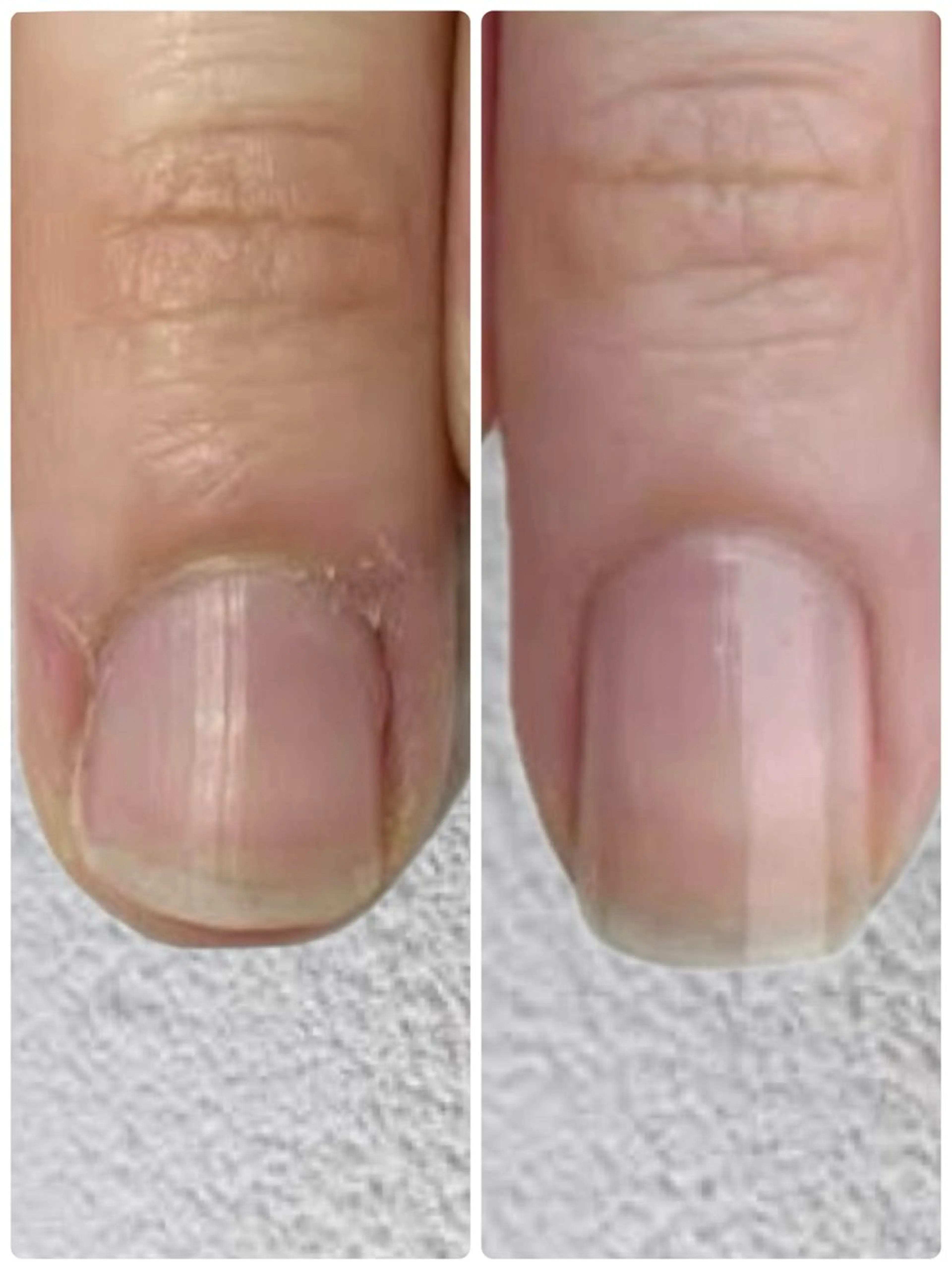 8回施術💅自爪育成モニターの写真