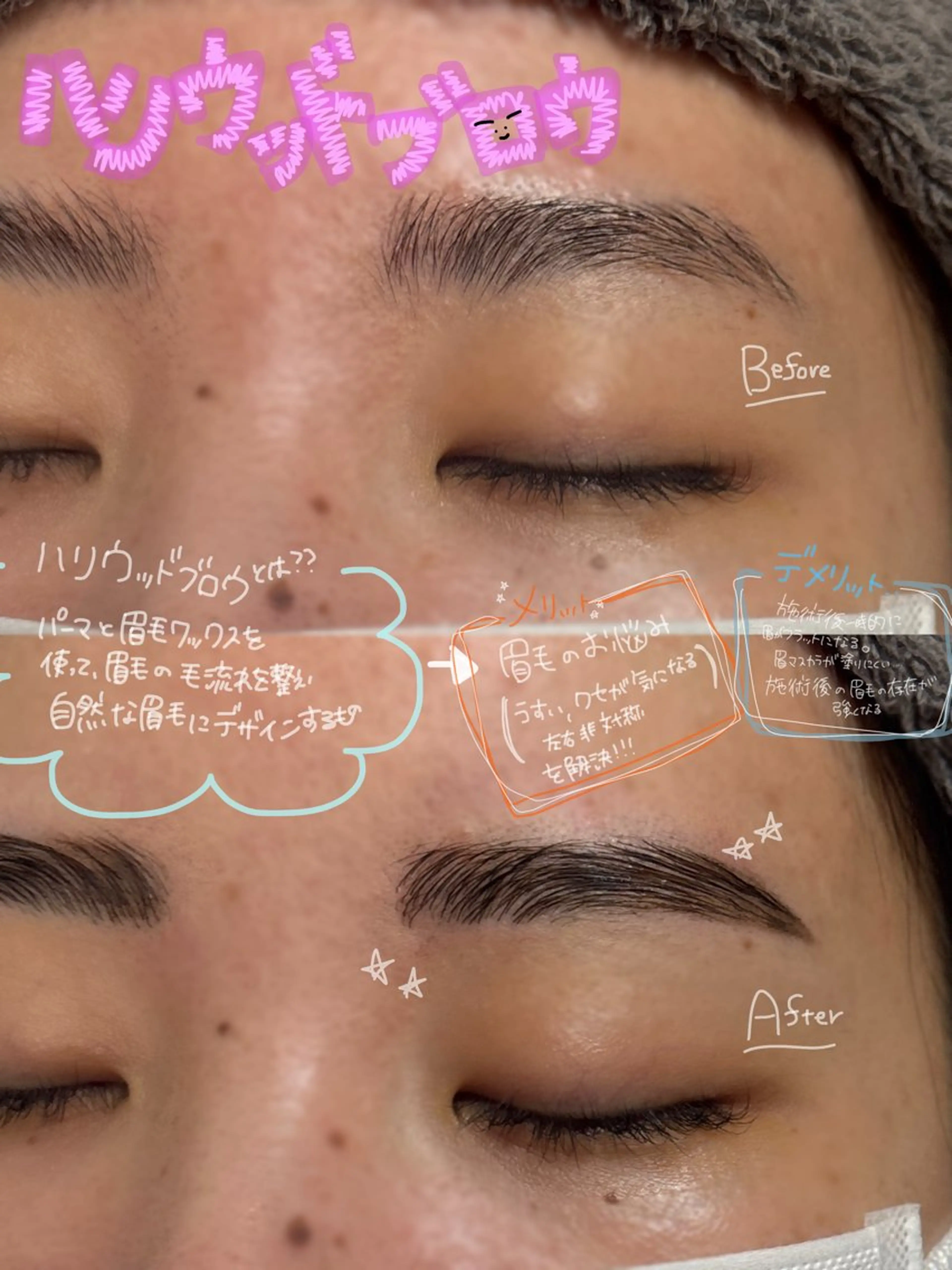 HBL(ハリウッドブロウリフト)の写真