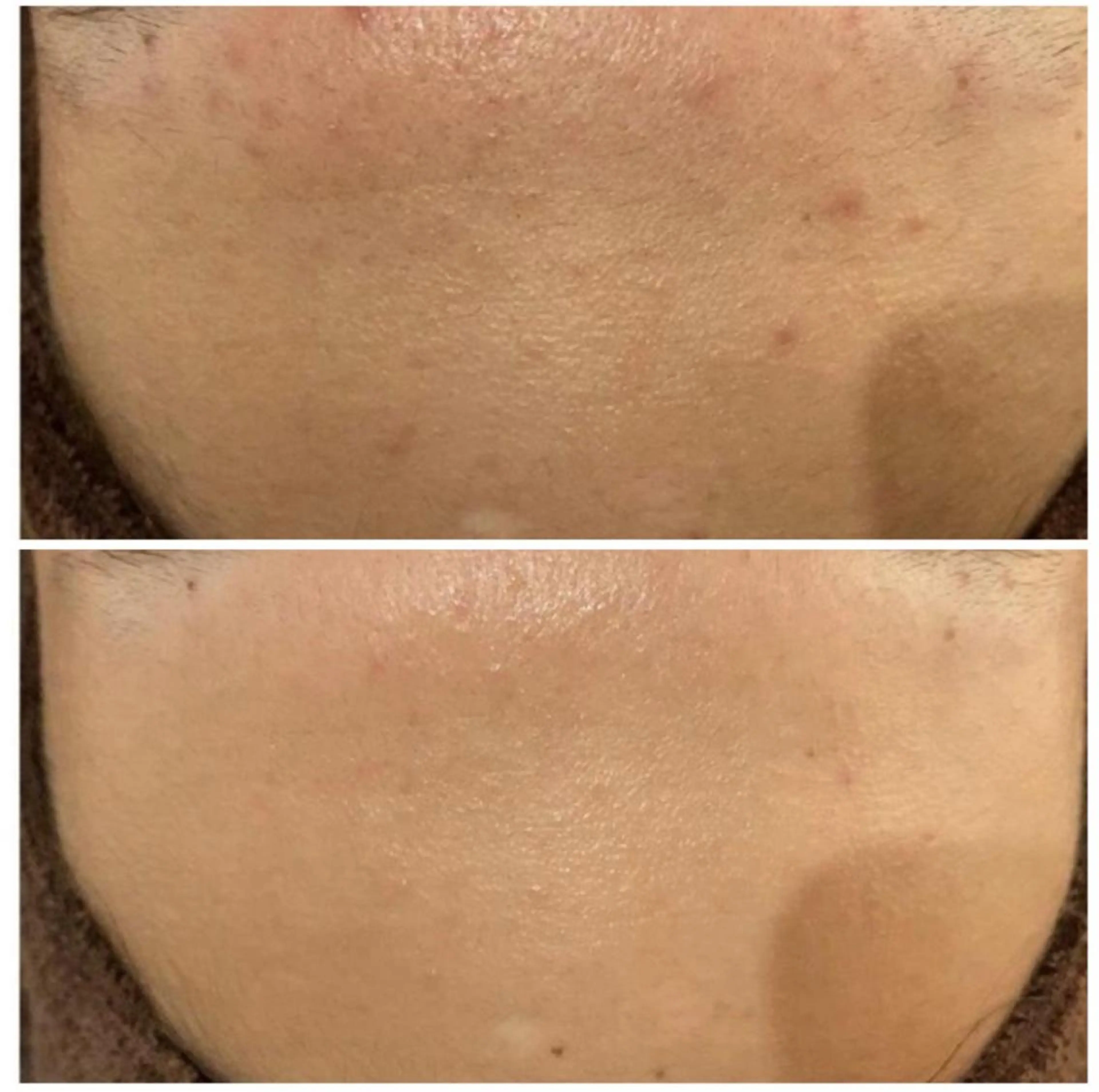 ニキビ跡改善専門🔥 医療にはできない改善のエステ・リラクイメージ