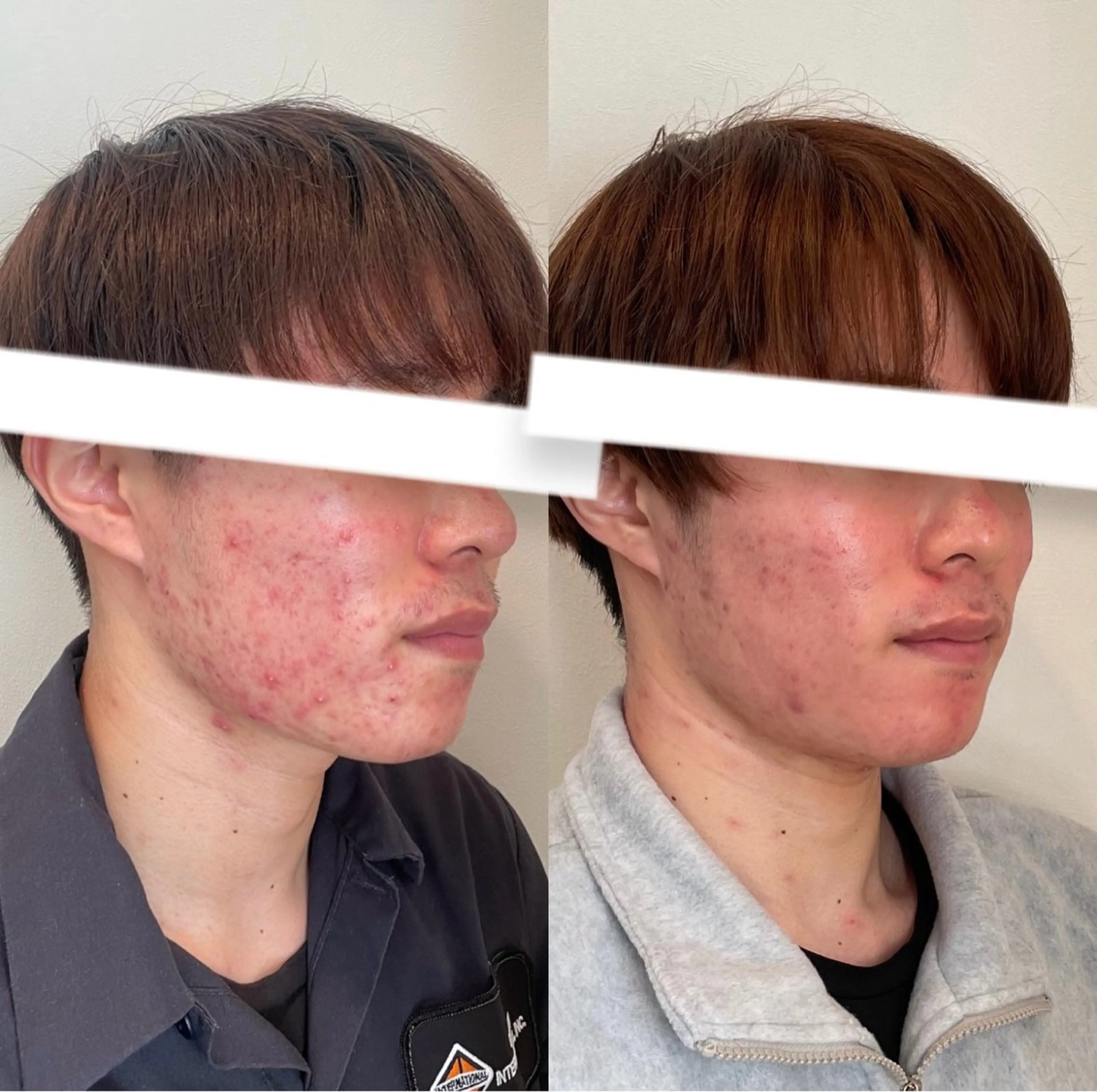 メンズ 美容鍼灸サロン　TIARA所属・鍼灸サロン TIARA　美容鍼のエステ・リラクイメージ