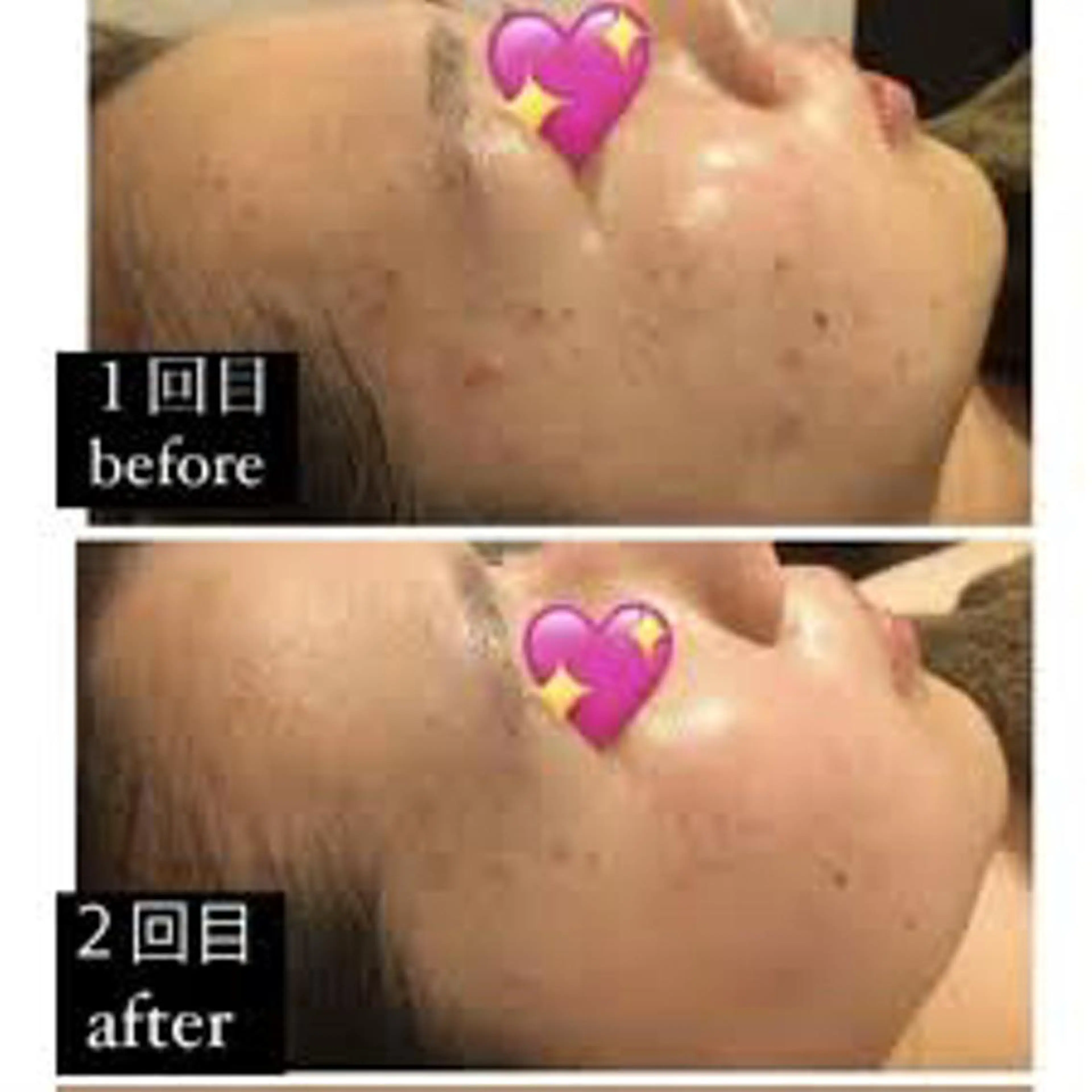 ハーブピーリング/韓国肌管理/フェイシャル/毛穴洗浄/眉毛/顔脱毛【糸脱毛専門】rev所属・ハーブピーリング🌹 毛穴洗浄❤️眉waxのエステ・リラクイメージ