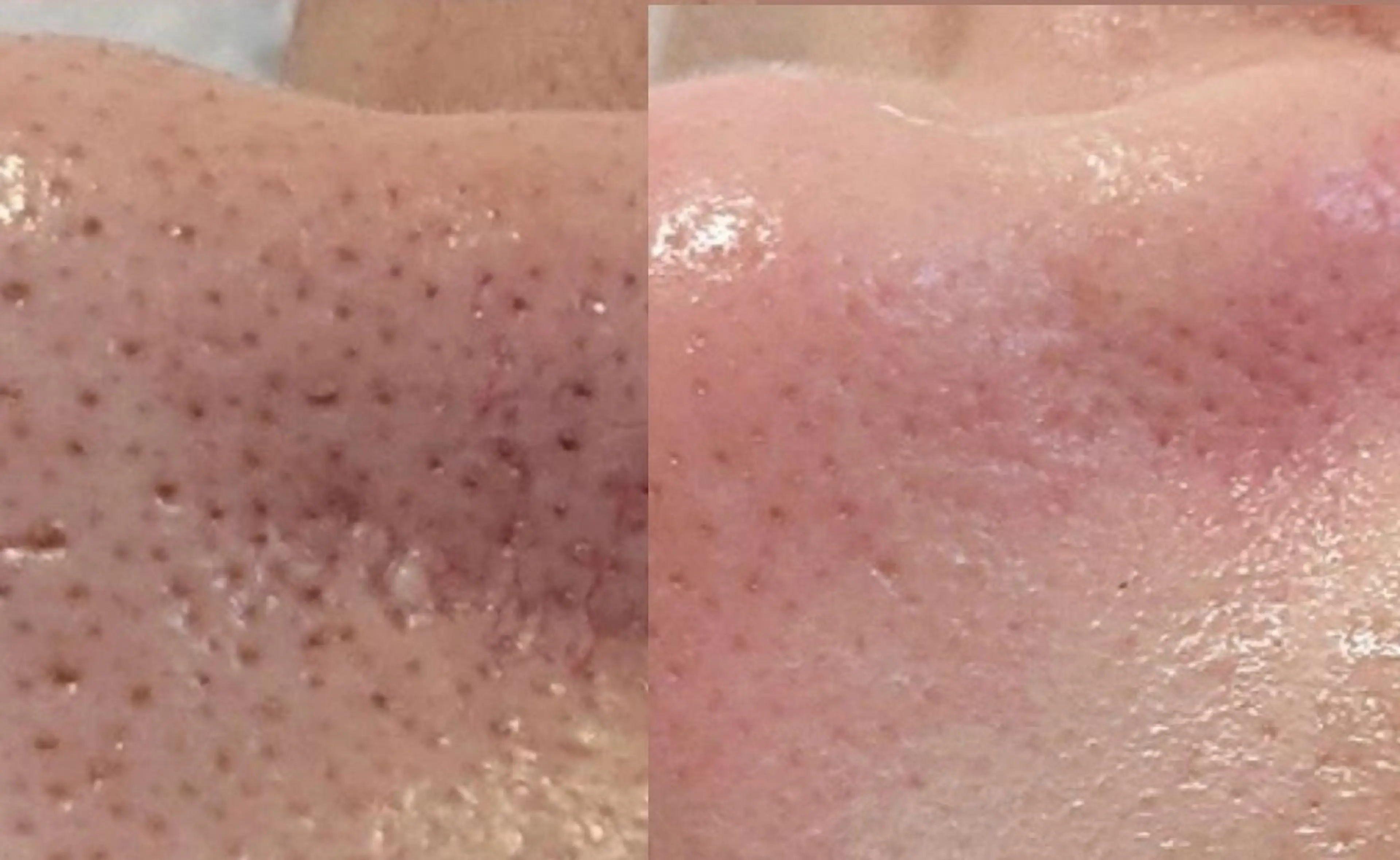 【水光肌】ハーブピーリング✨剥離なし🕛ダウンタイムなし！ニキビ跡、シミ、くすみが気になる方🫧の写真