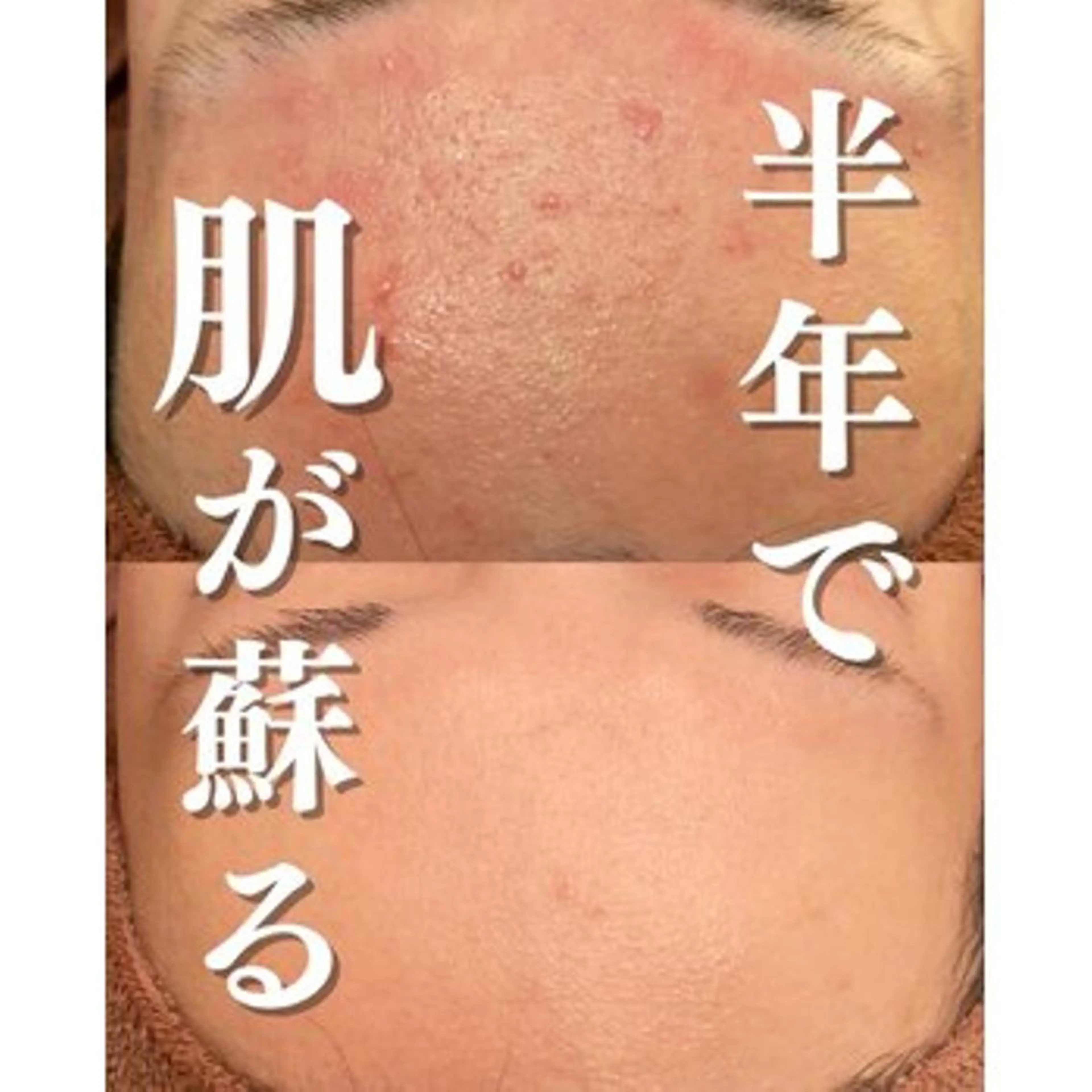 ニキビ特化型エステ 🍓最短で肌質改善のエステ・リラクイメージ