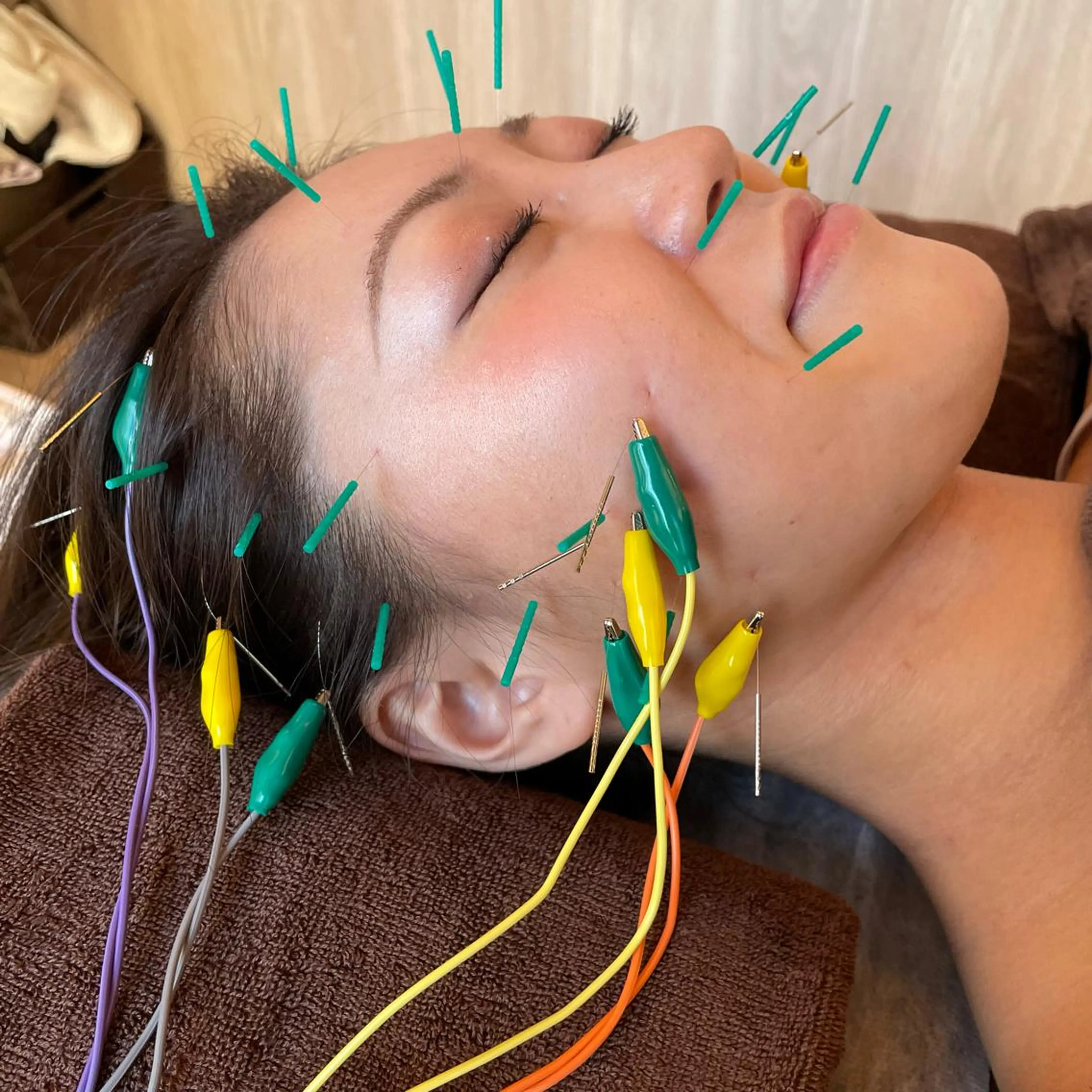 美容鍼37本へ通電［電気美容鍼］心地良い通電がよりお顔や頭皮を刺激し血流改善✨透明感のある素肌へ✨の写真