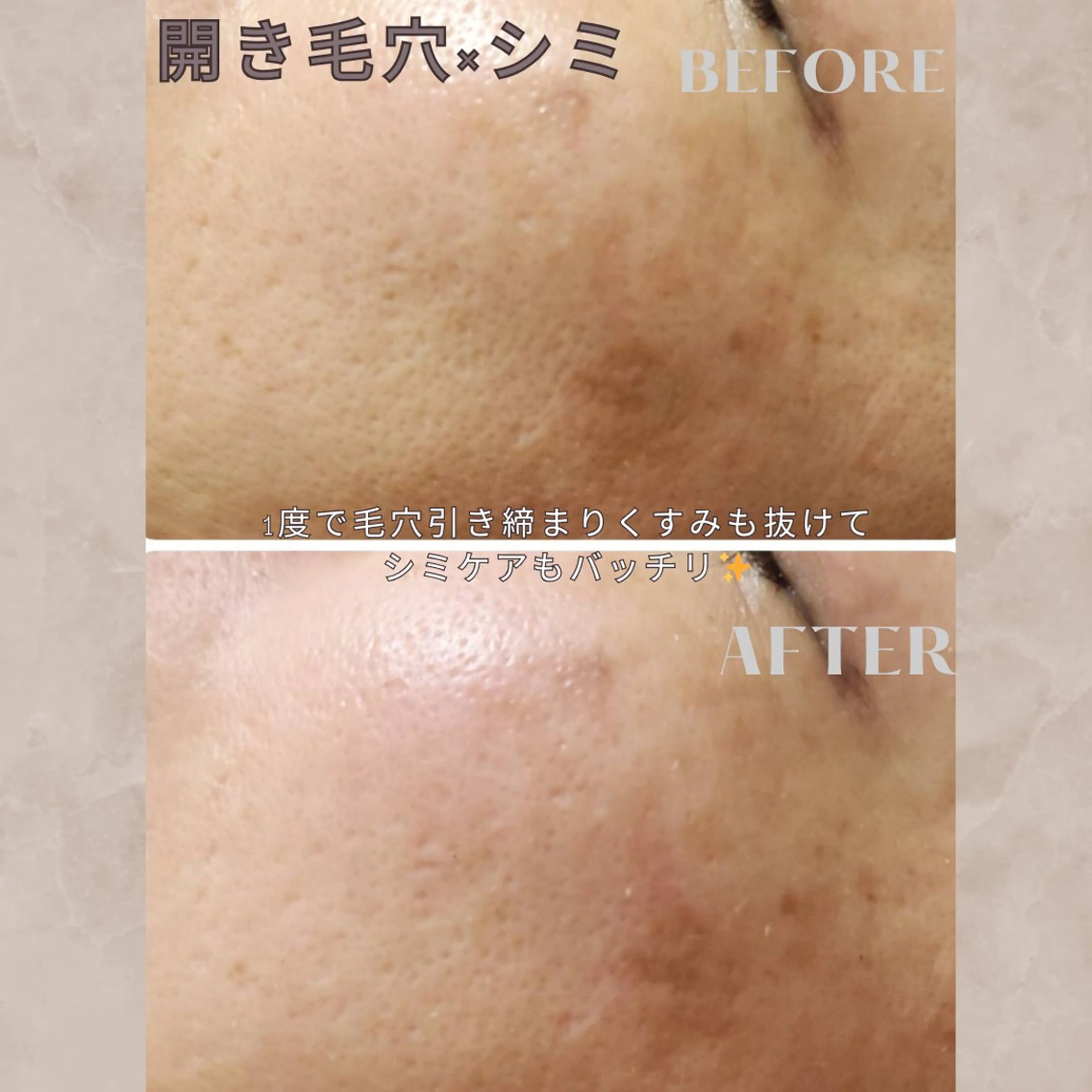 【毛穴トラブル特化コース】お試し🔥ダウンタイム痛みなし✖️毛穴トラブルでお悩みの方🌼幹細胞ハーブピーリング🌿90分の写真