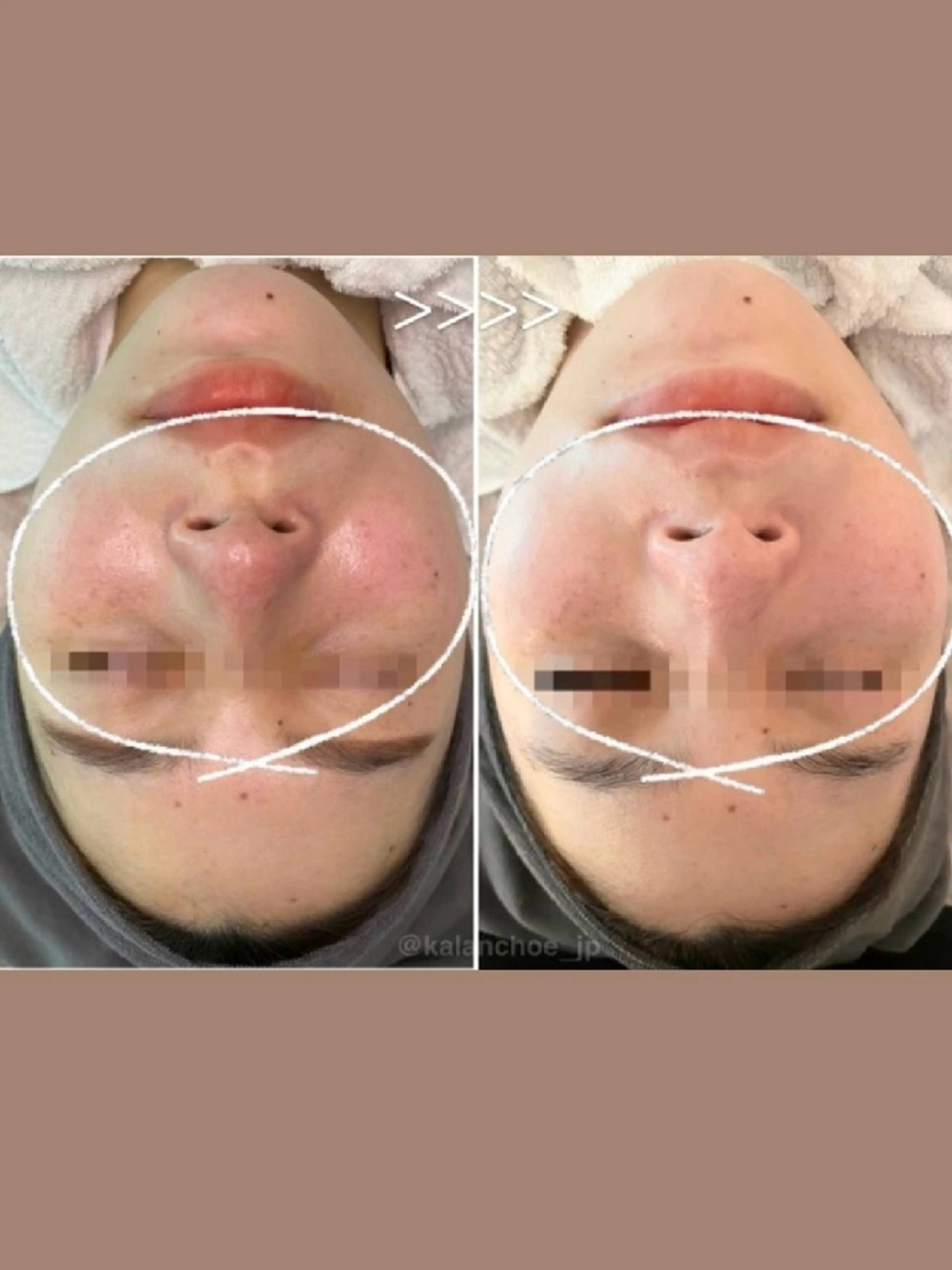 肌質改善 KALANCHOEのエステ・リラクイメージ