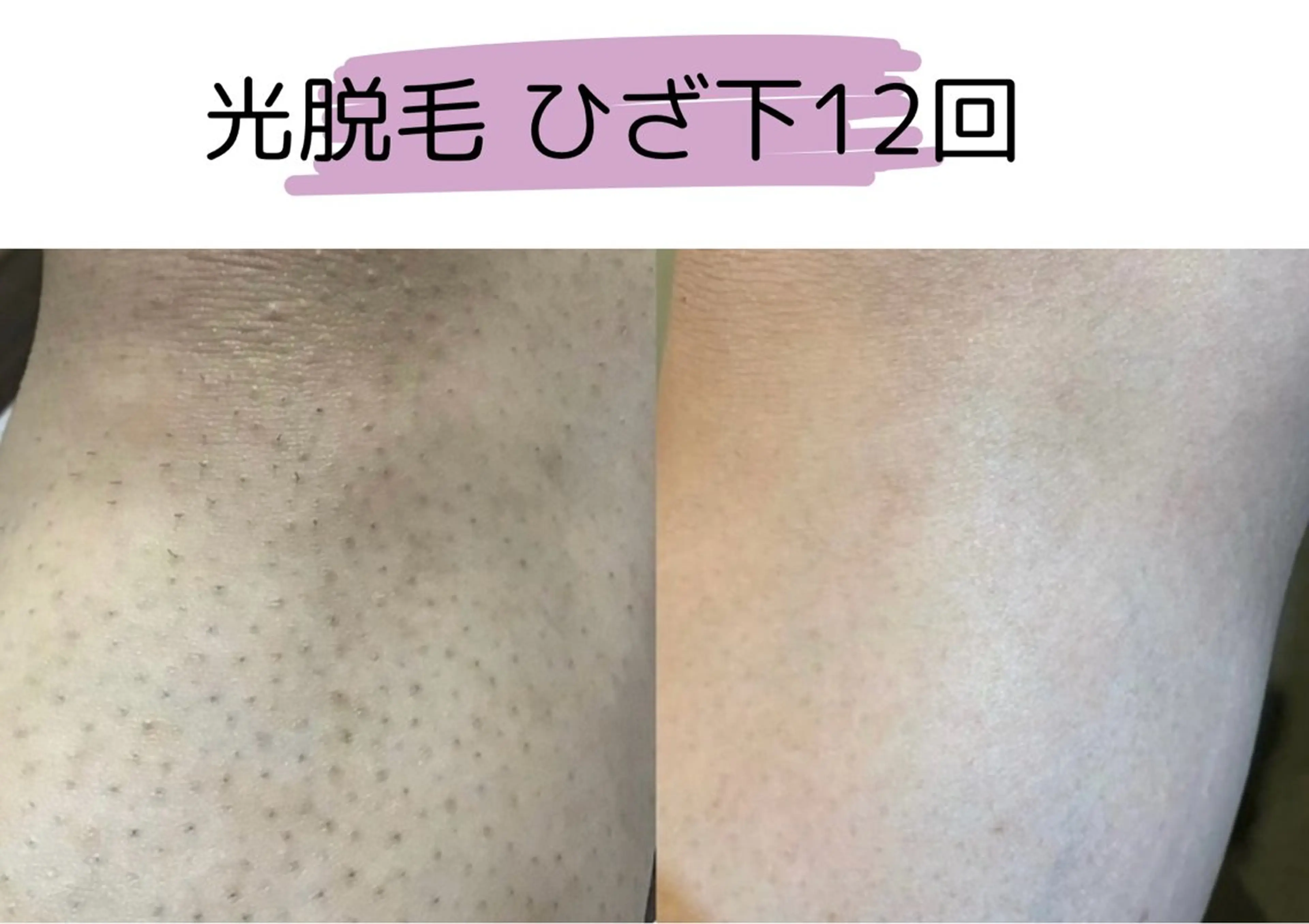 キッズ エステサロン TRINTEのエステ・リラクイメージ