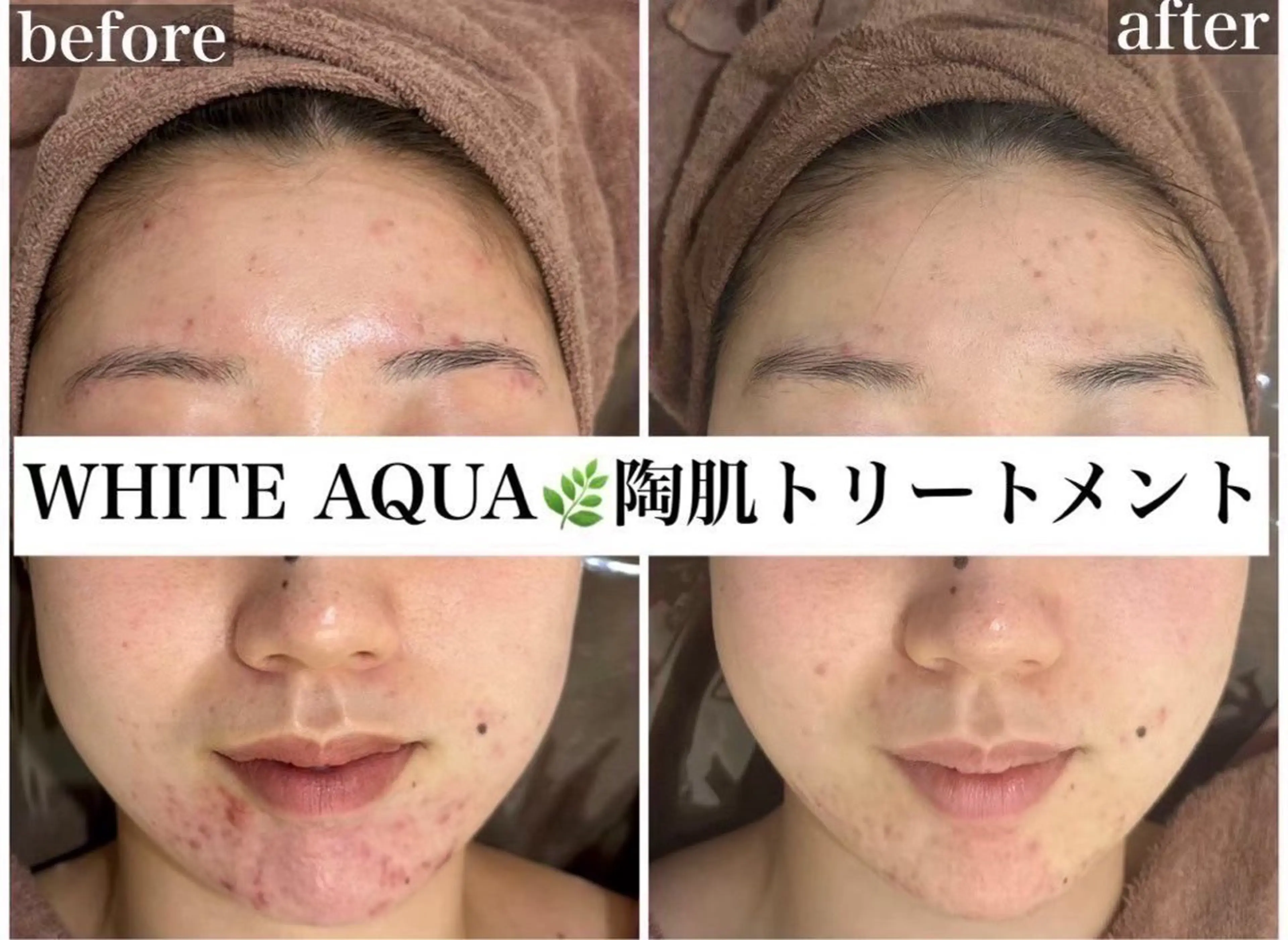 ルビーハーブピーリング＋デコルテマッサージ付き🫧ニキビ、毛穴、小顔、ピーリング、フェイシャル、黒ずみがお悩みの方！の写真