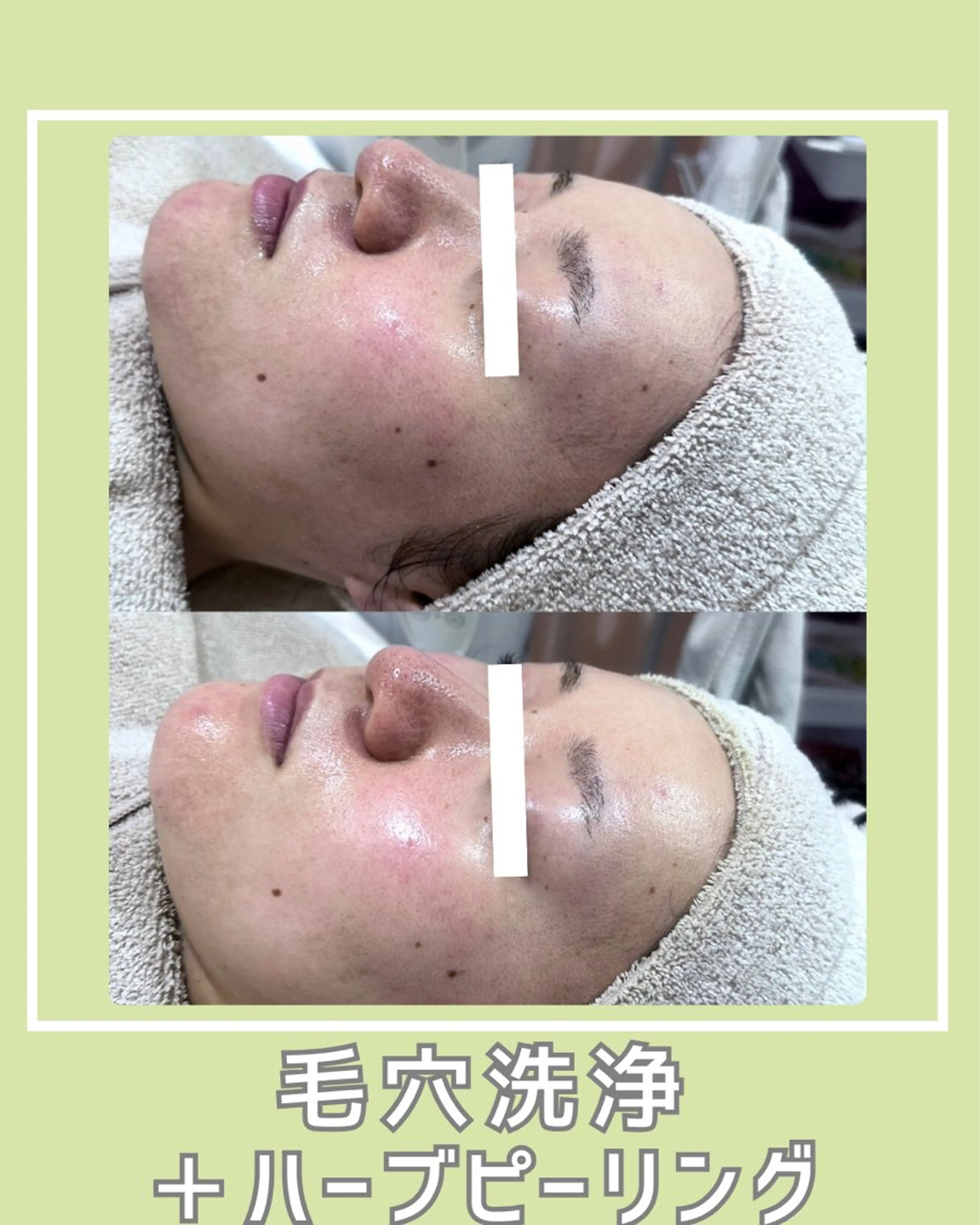 エステ |ピーリング・毛穴| soina神楽坂のエステ・リラクイメージ