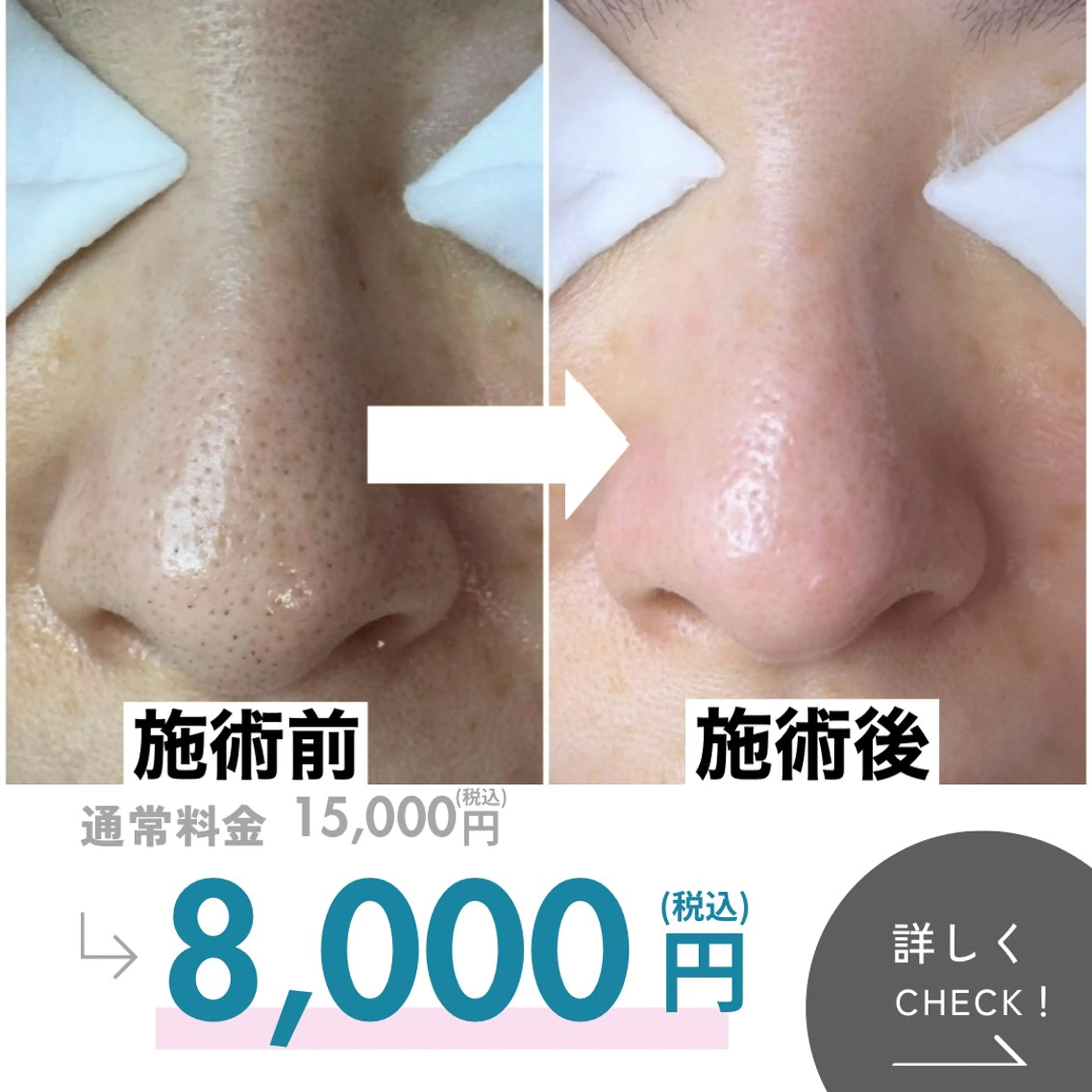 エステ 最速 毛穴シミ改善 いくえのその他イメージ