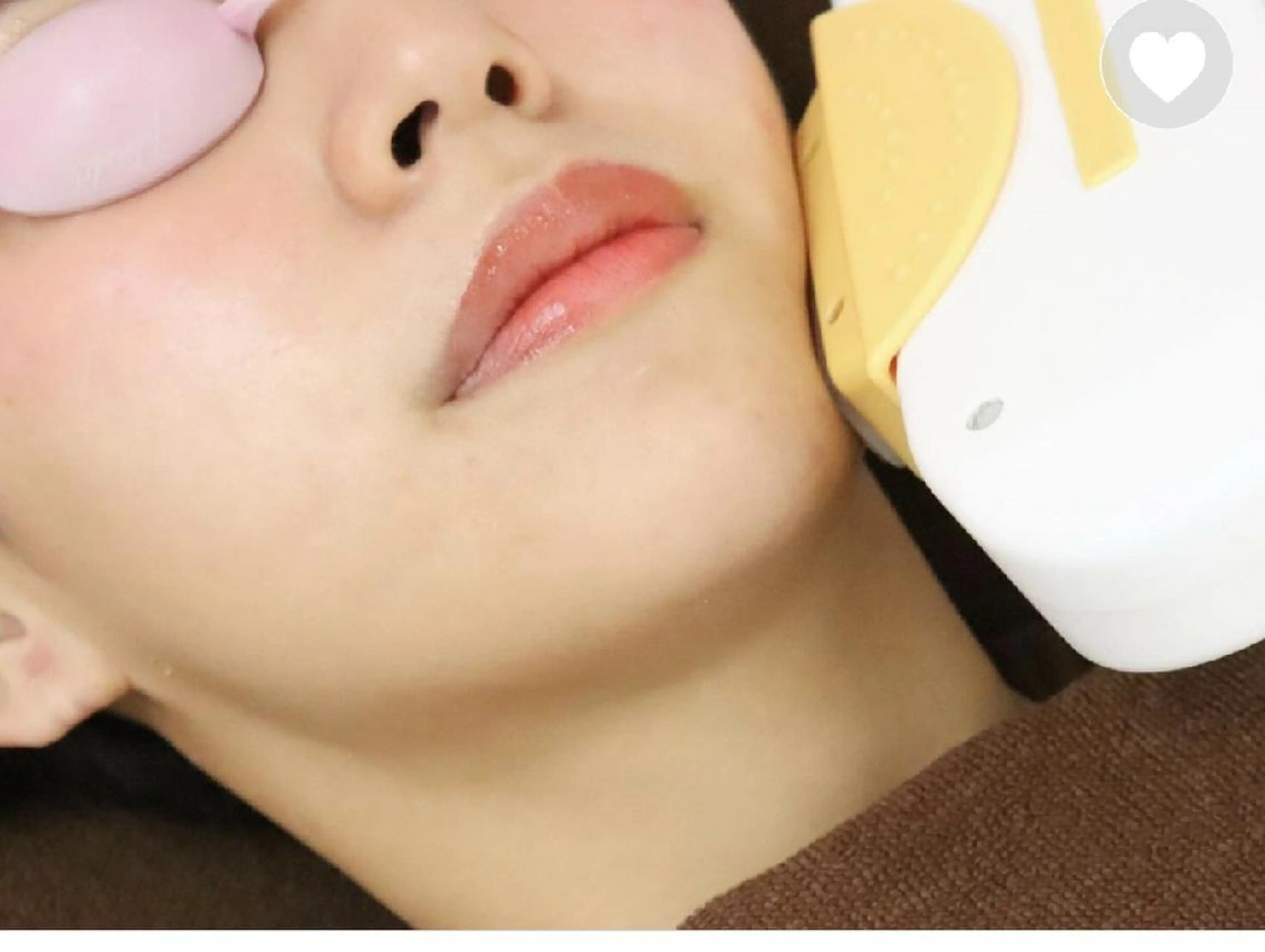 【お顔まるごと脱毛+保湿うるつやパック付✨】¥3000くすみ、化粧ノリ改善に☆の写真