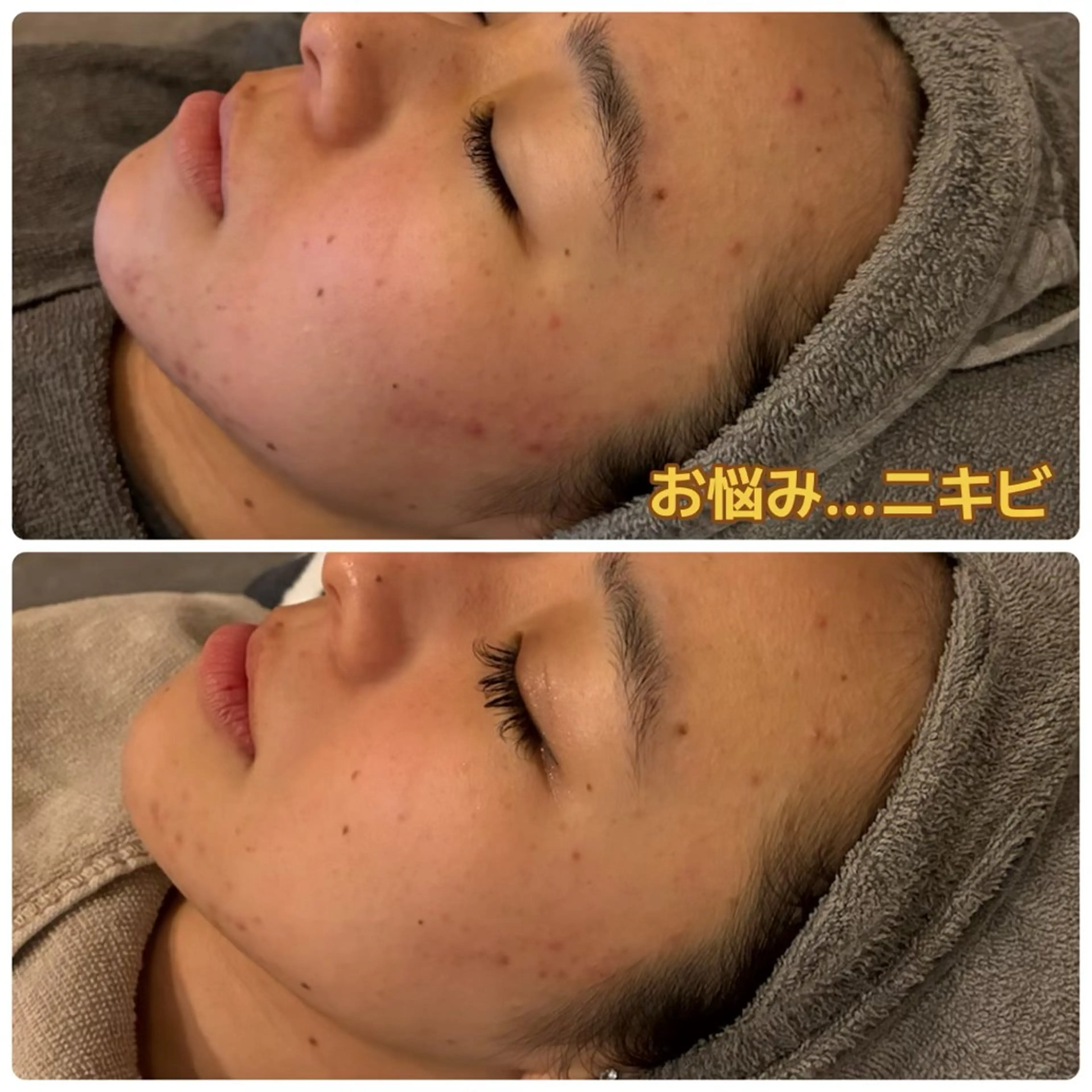 脱毛 yellow.所属・yellow💛【 脱毛&フェイシャル】のエステ・リラクイメージ