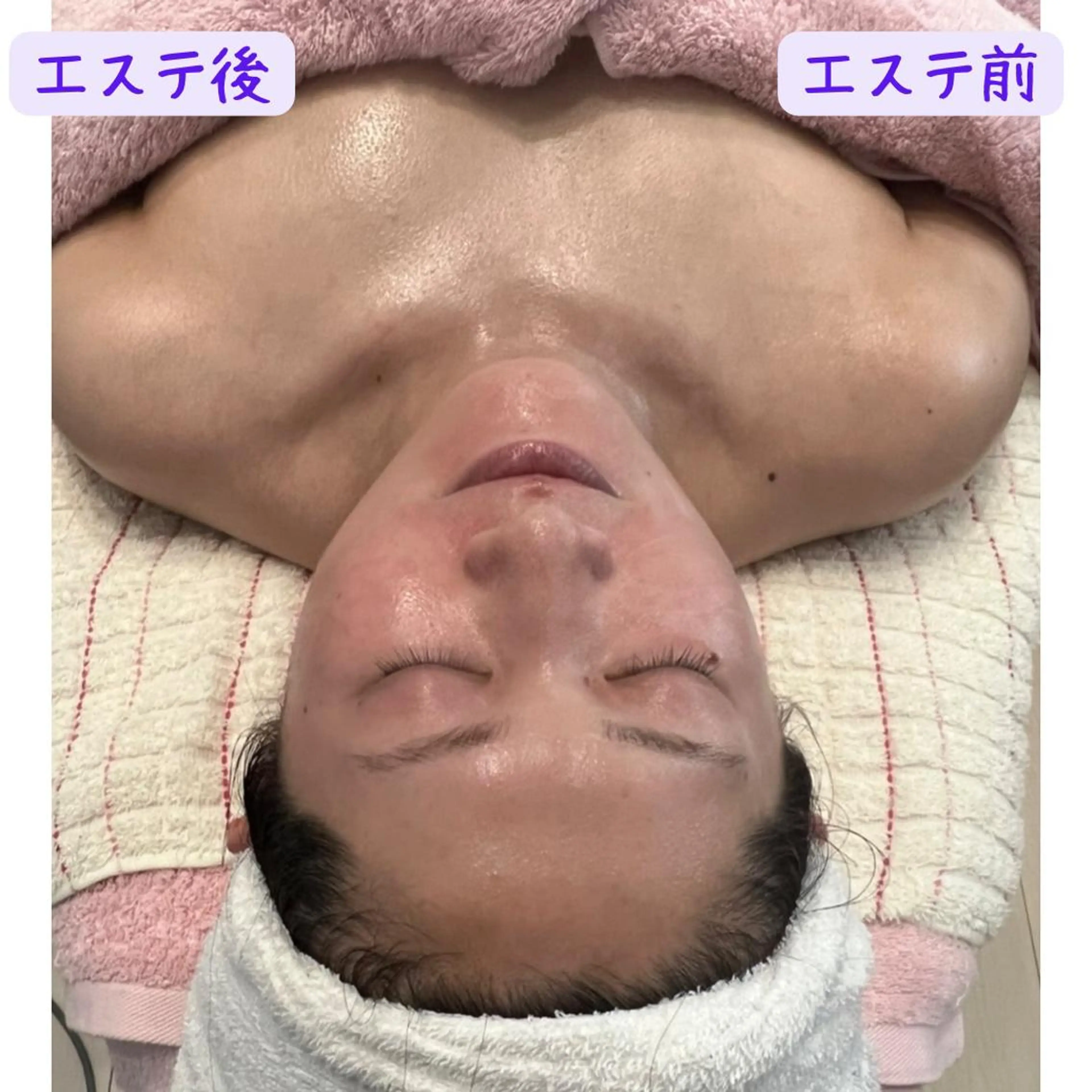 イルネージュ使用✨✨毛穴汚れすっきりアドバンスコース❤️の写真