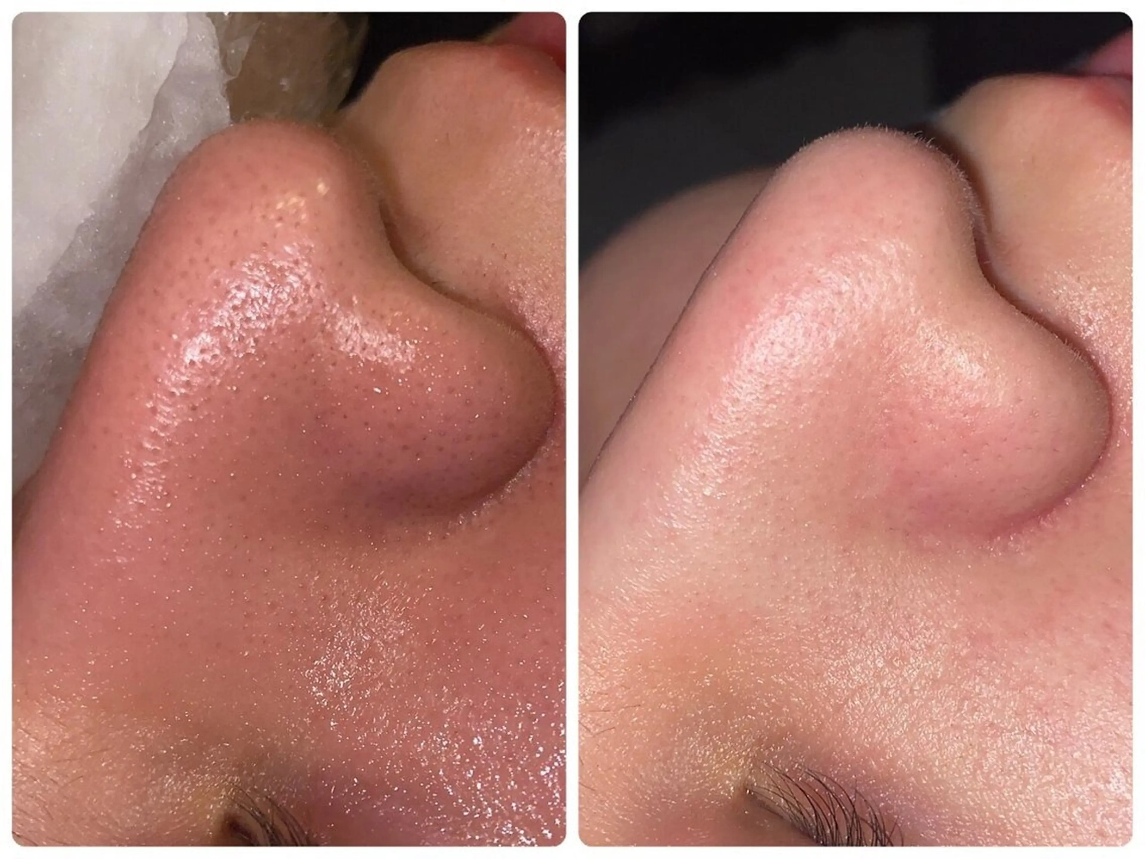 【黒ずみ毛穴を徹底改善】詰まりをクリアにし、キメの整った美肌へ導くコースの写真