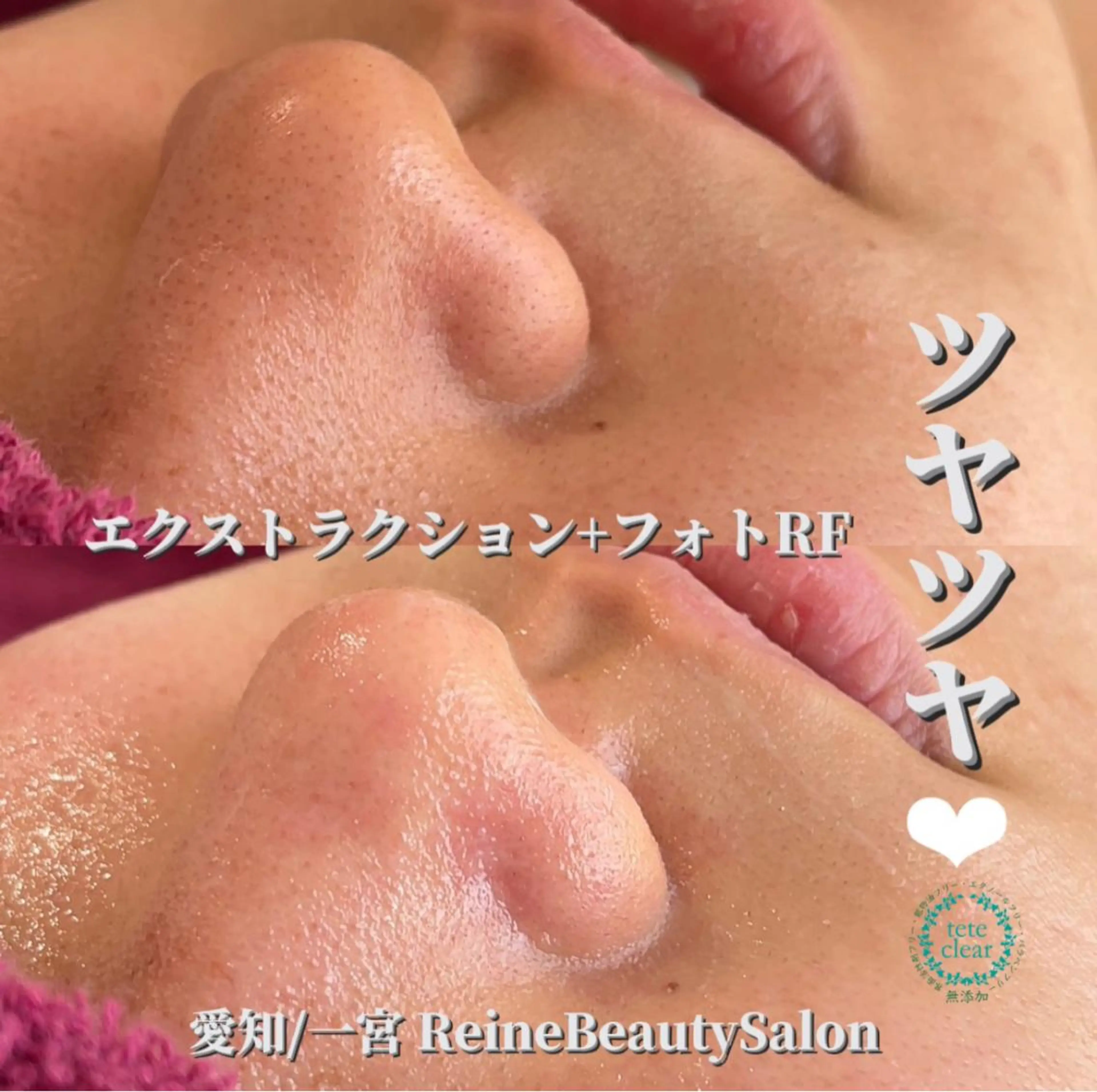 エステ Reine BeautySalon所属・毛穴/シミ肝斑/脱毛 横山梨里のエステ・リラクイメージ
