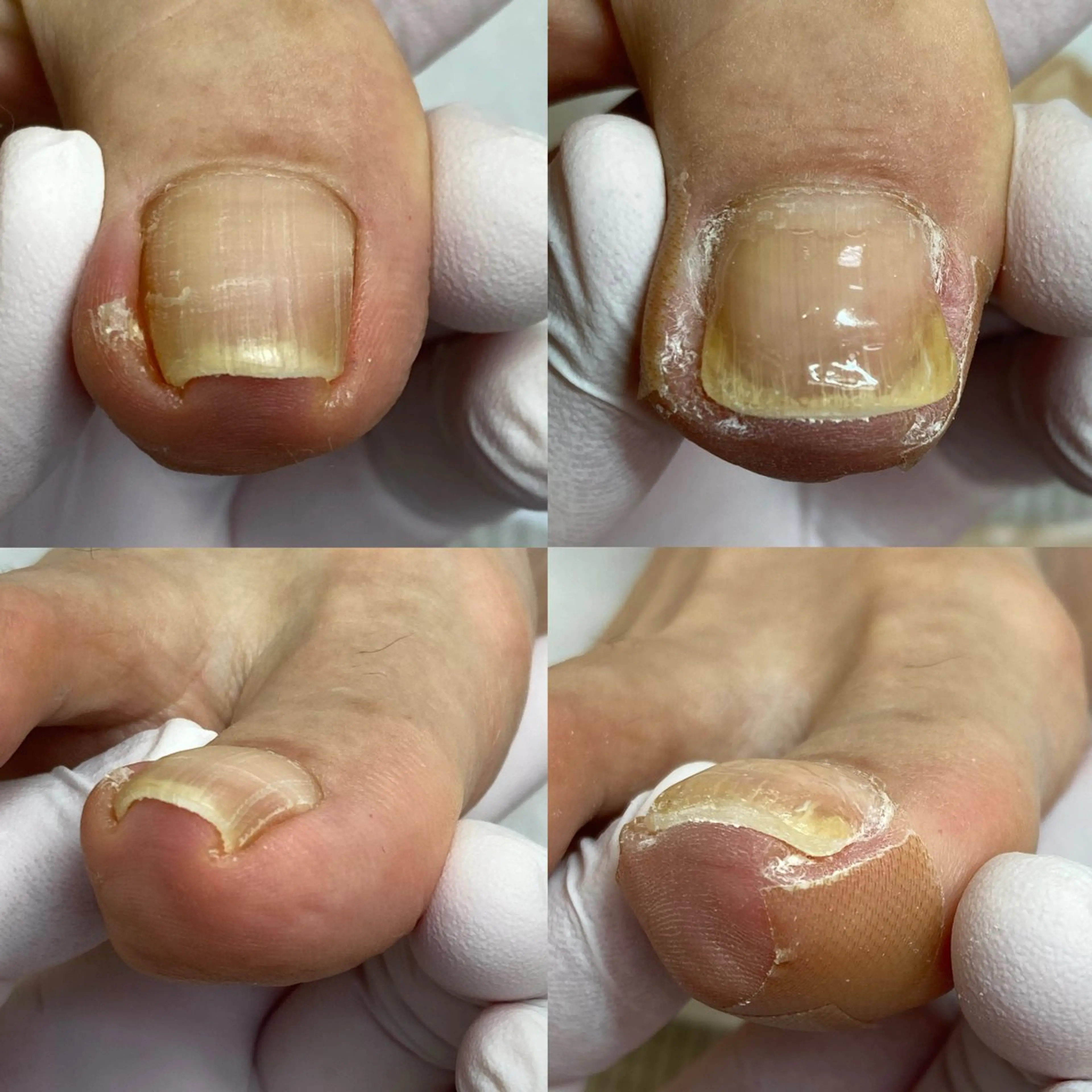 その他(ネイル) 北千住巻き爪矯正院フルフィル所属・北千住巻き爪矯正院 フルフィルのネイルデザイン