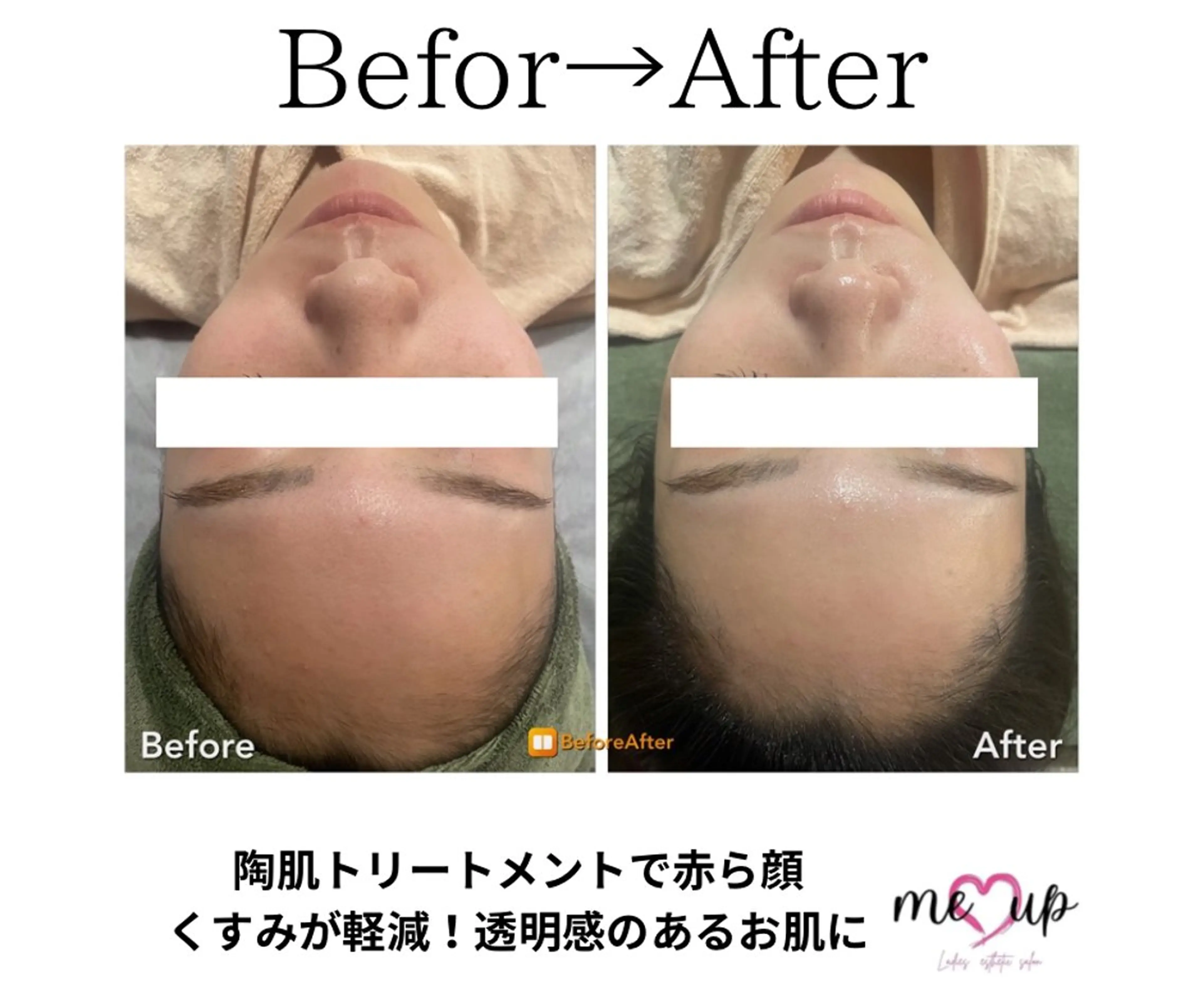 エステ Meupニキビ専門店 背中/ハーブ/肌管理のその他イメージ