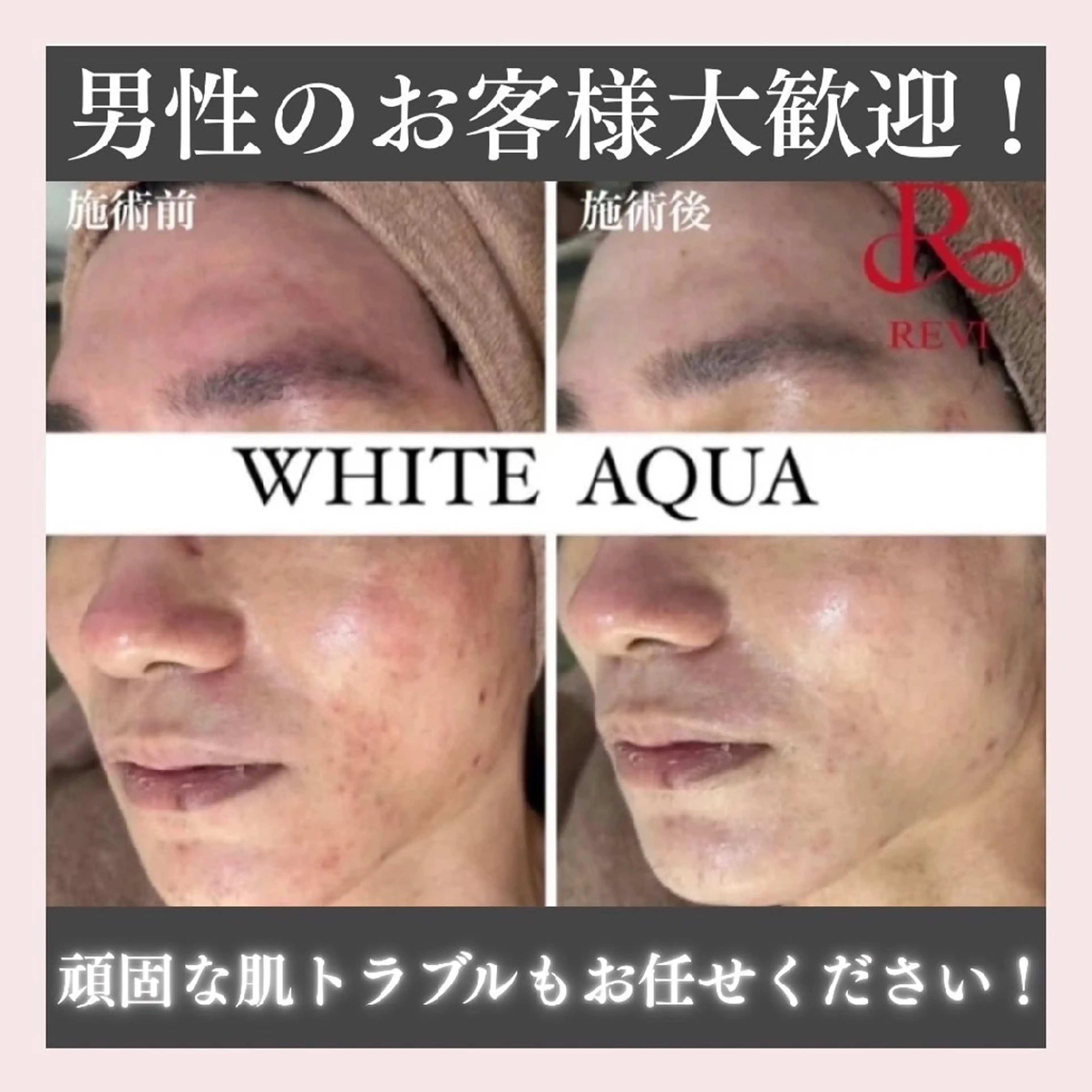 メンズ限定🌿【13,000円→🫠6,800円】ハーブピーリング☆デコルテマッサージ付☆ダウンタイムなし☆の写真