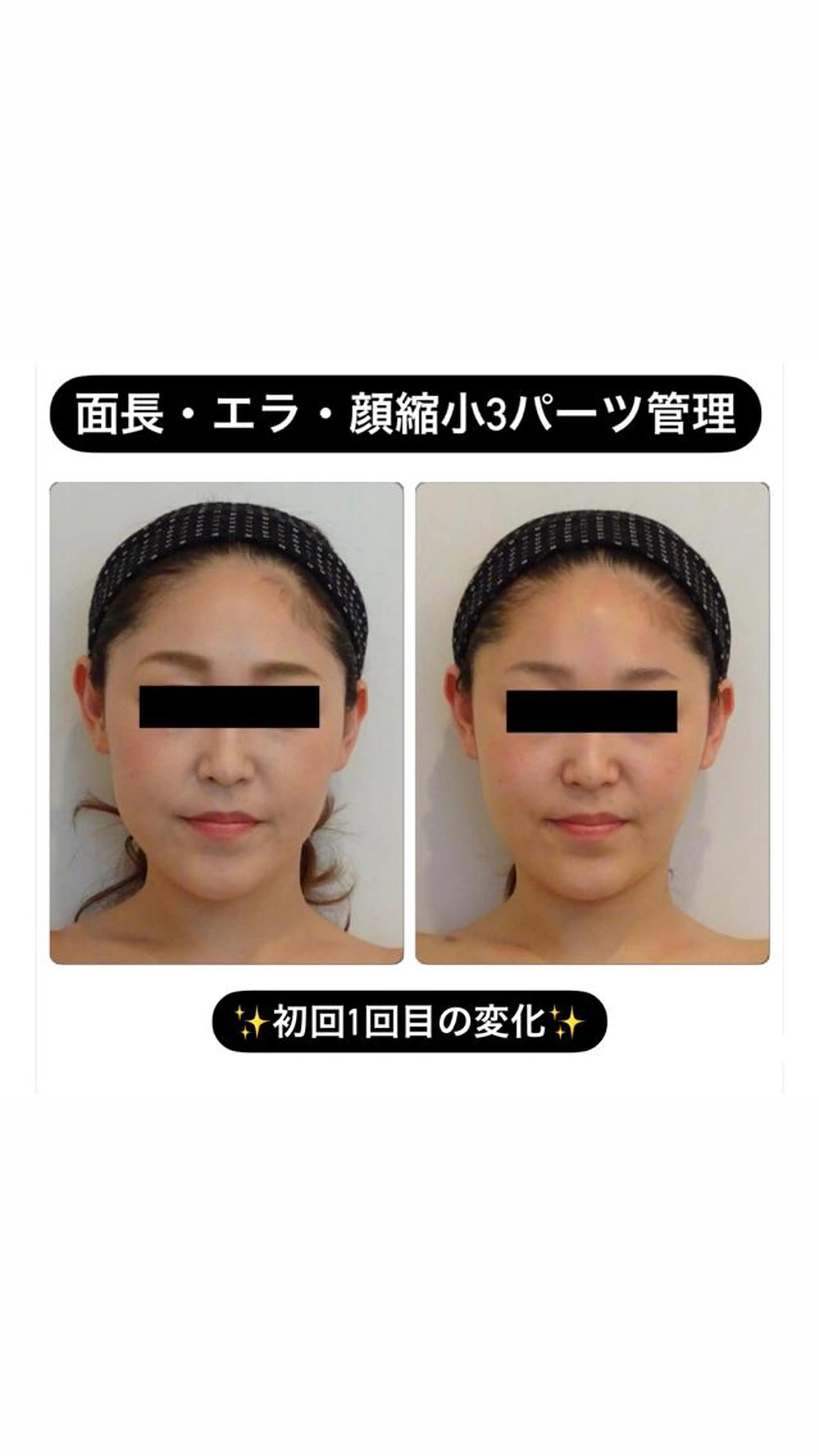 ✨極上小顔✨究極の3パーツ小顔矯正💆‍♀️一回で劇的な変化をお望みの方はこちらがオススメ💗80分の写真