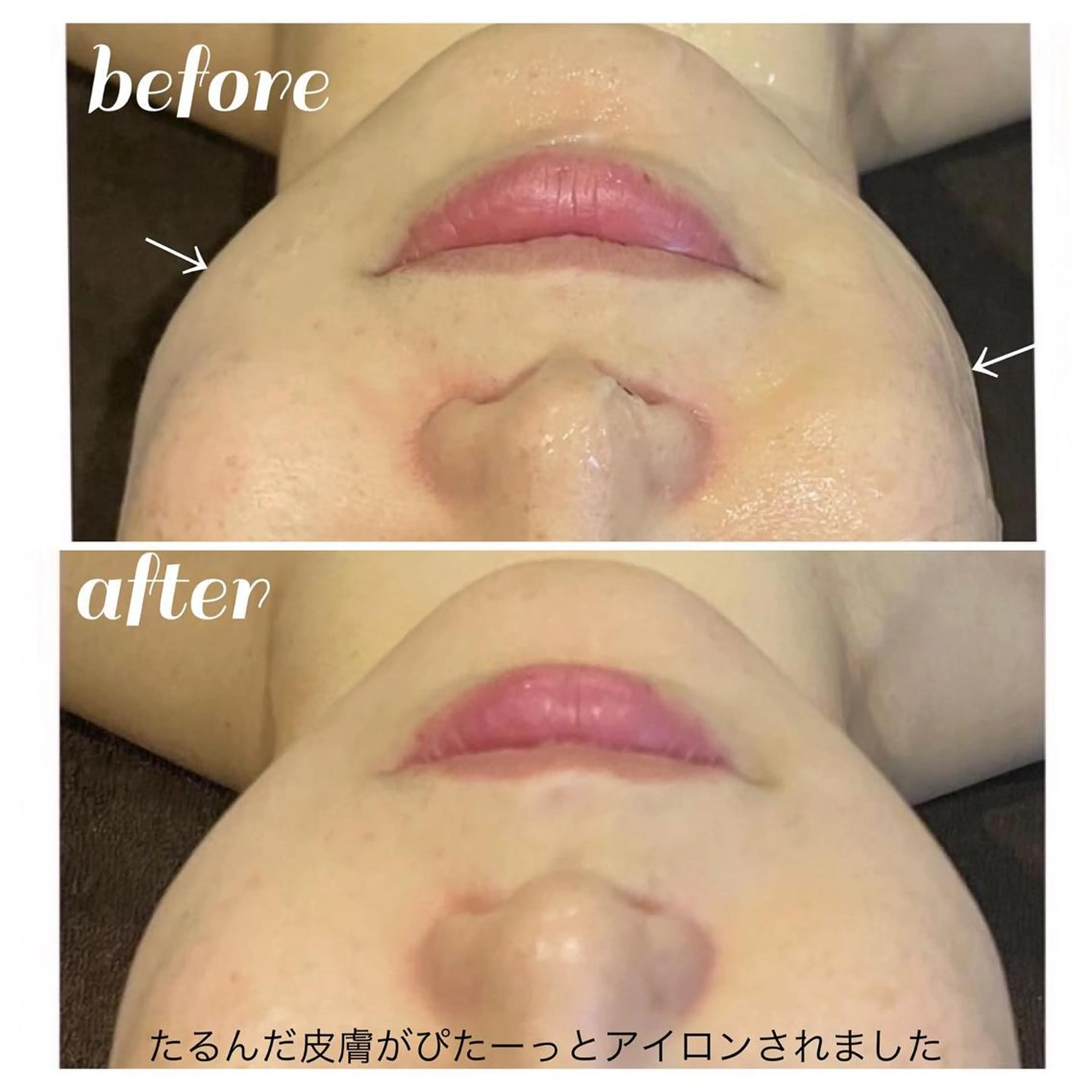 【ニキビ/肌管理】 salon varyのエステ・リラクイメージ