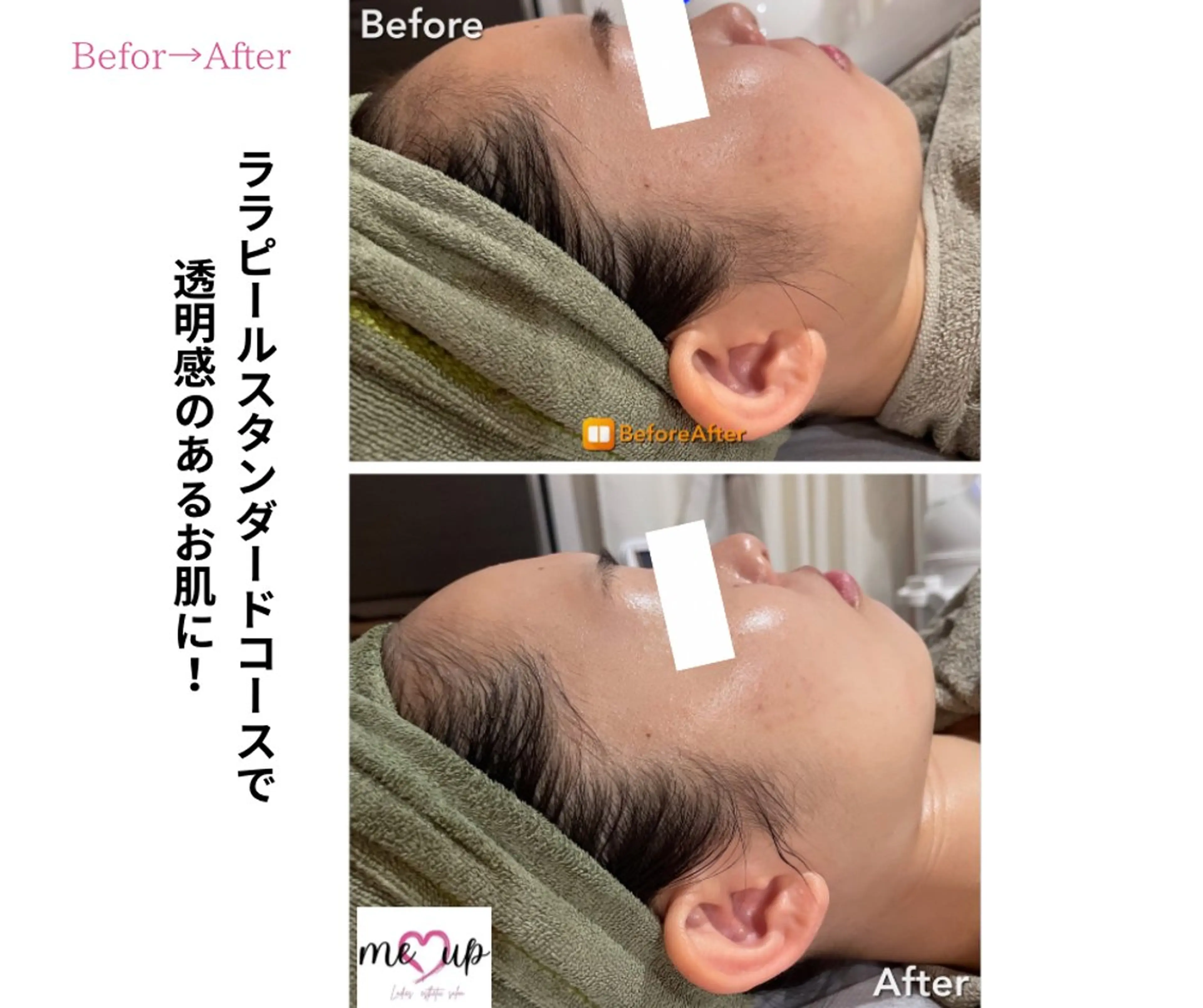 エステ Meupニキビ専門店 背中/ハーブ/肌管理のその他イメージ