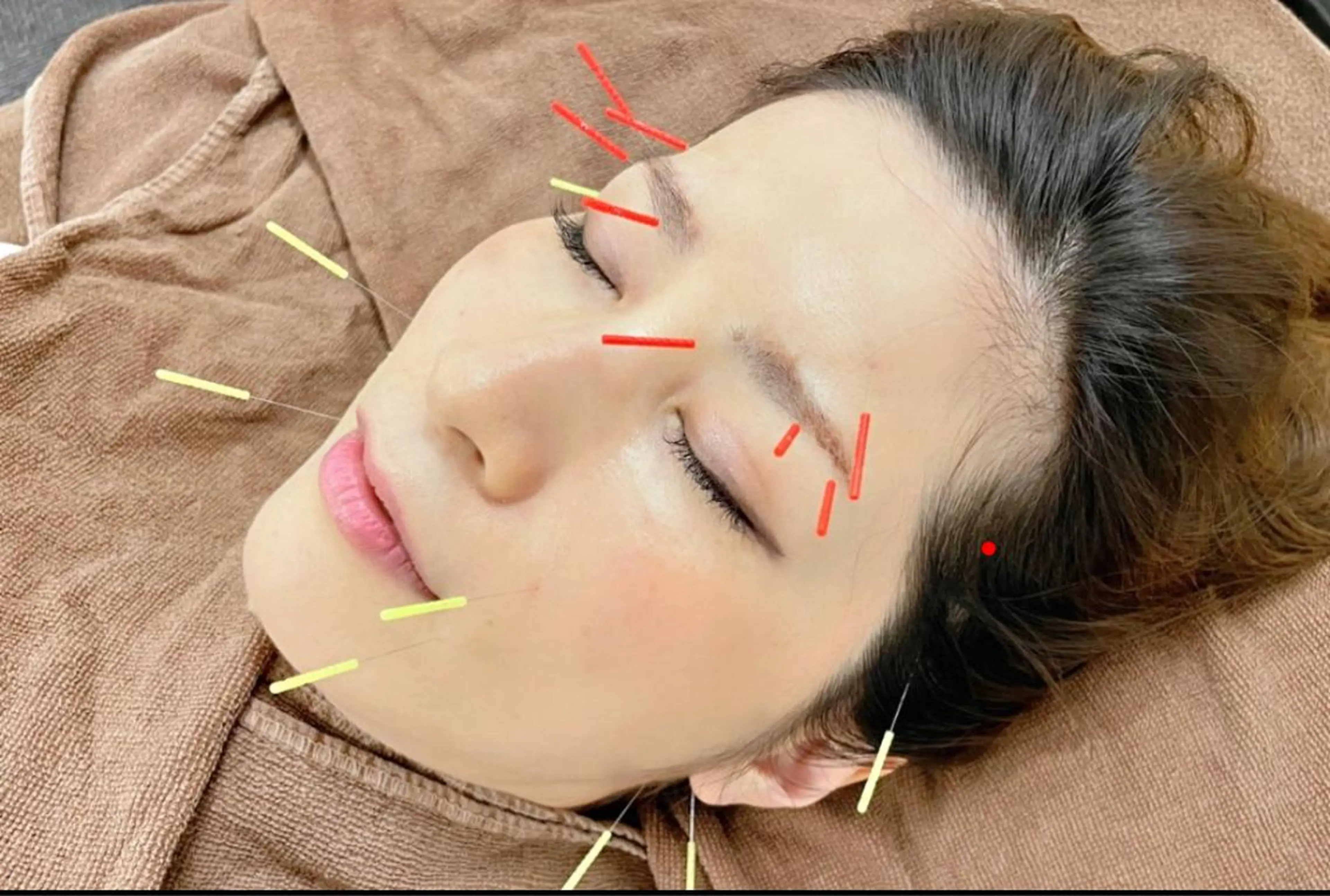 ハリウッド美容鍼灸®︎の写真