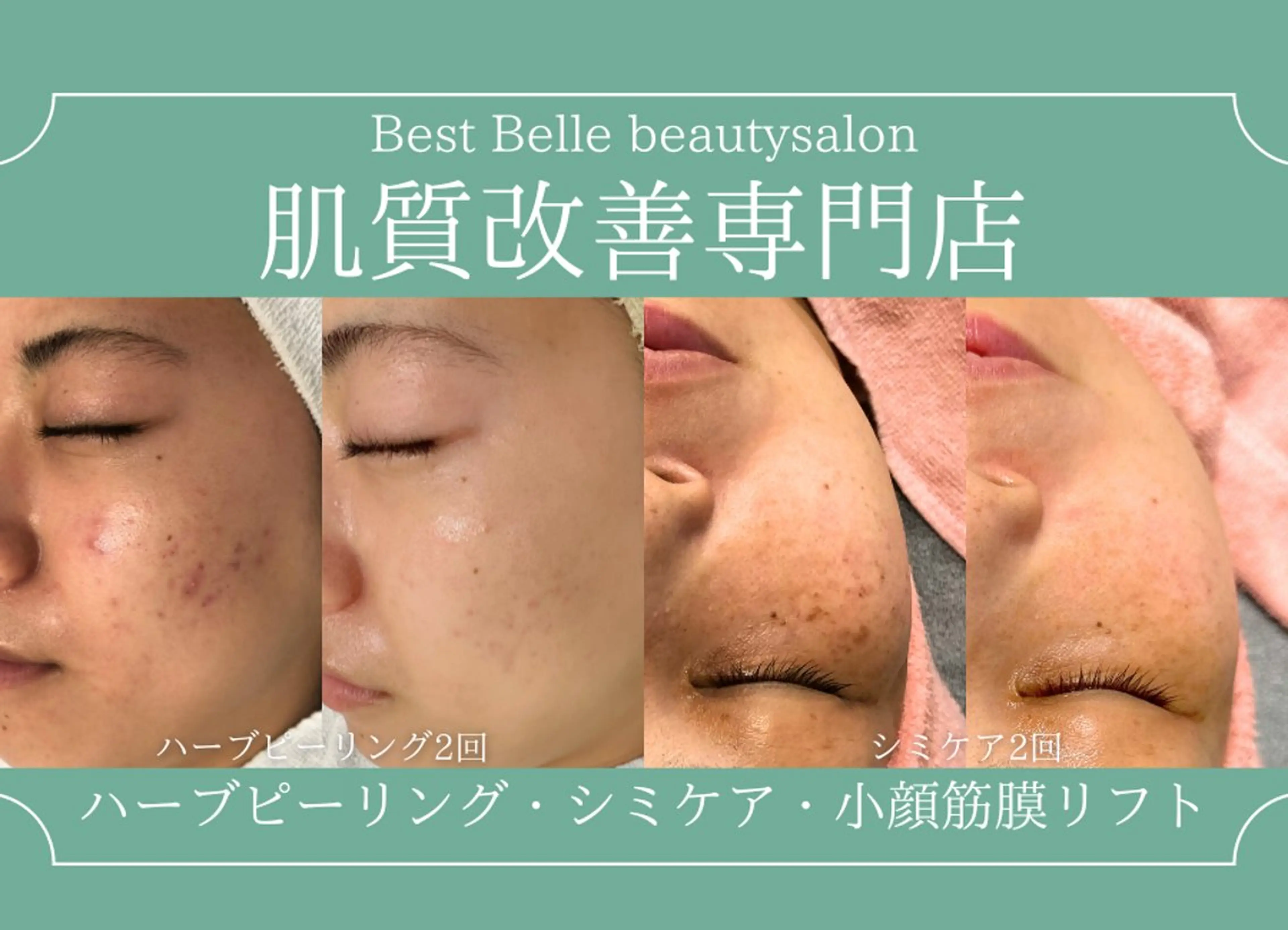 エステ BestBelleꕤ 大阪福島/肌質改善のエステ・リラクイメージ