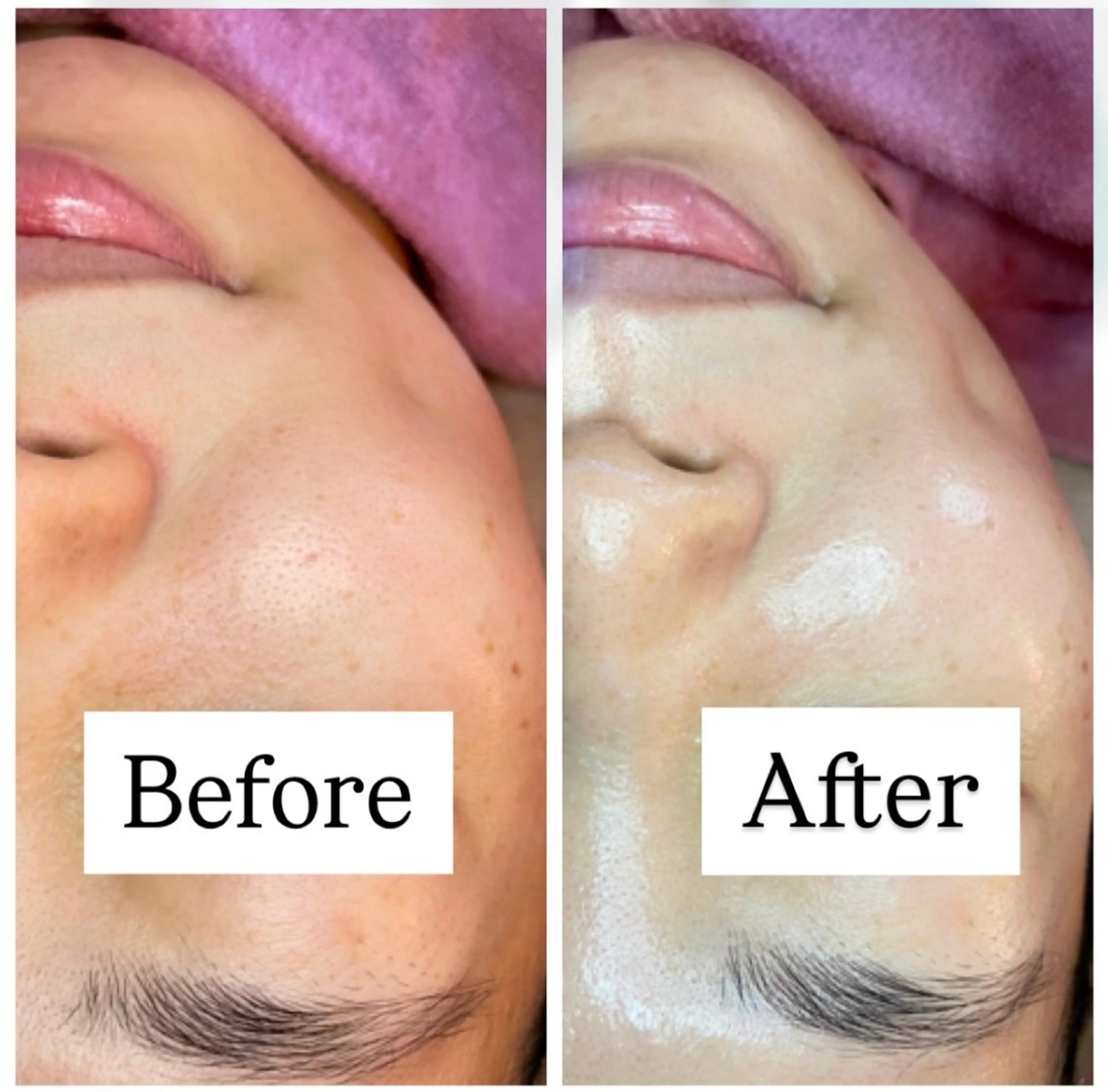 ◇肌質改善◇🧚ピーリング、むくみ撃退、つや肌美容液導入🫧/贅沢たっぷり80分コース💆‍♀️の写真