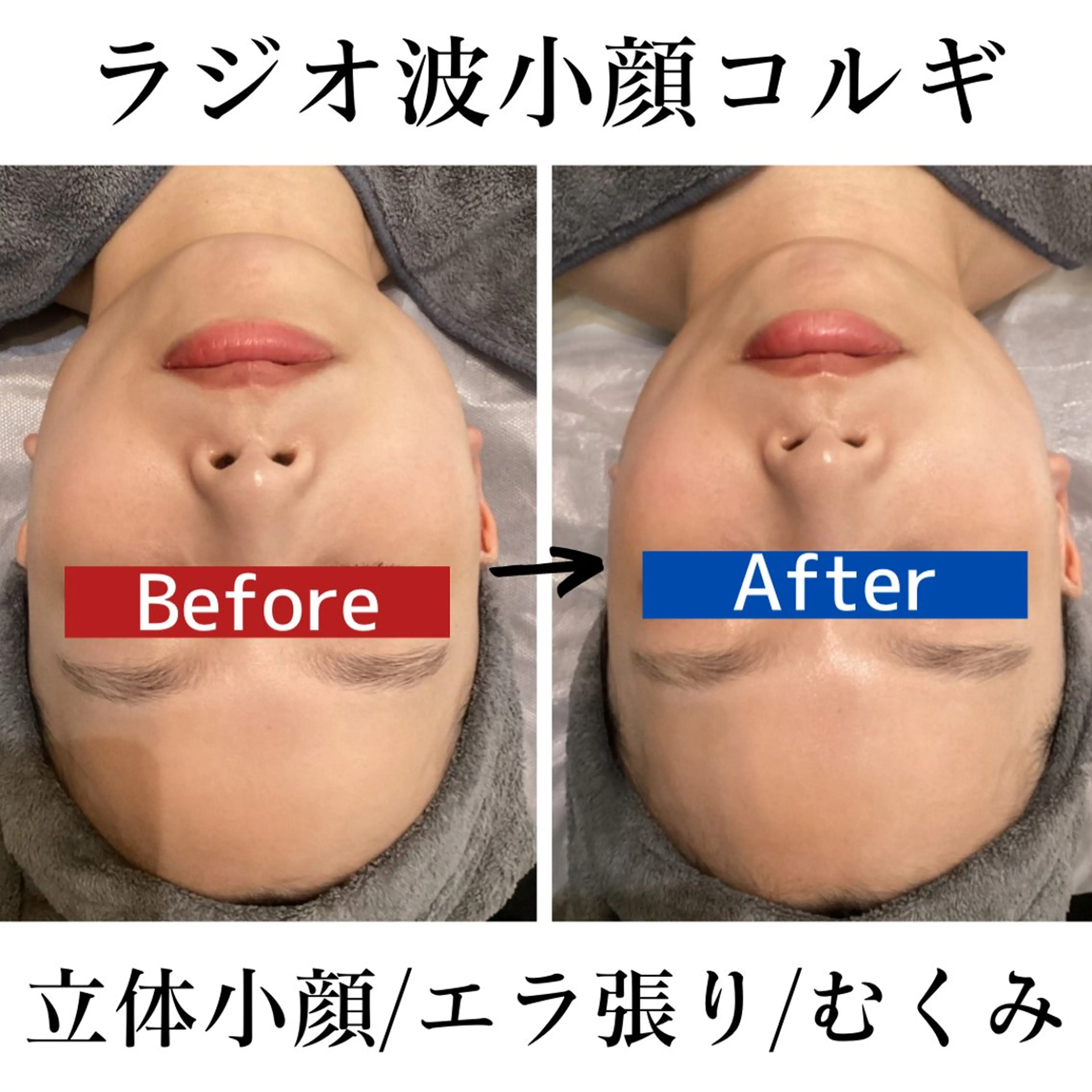 立体小顔♪ラジオ波コルギフェイシャル❤️‍🔥リフトアップ・二重あご・シワ・たるみ他、脇肉ケア！ブライダルにも人気✨の写真