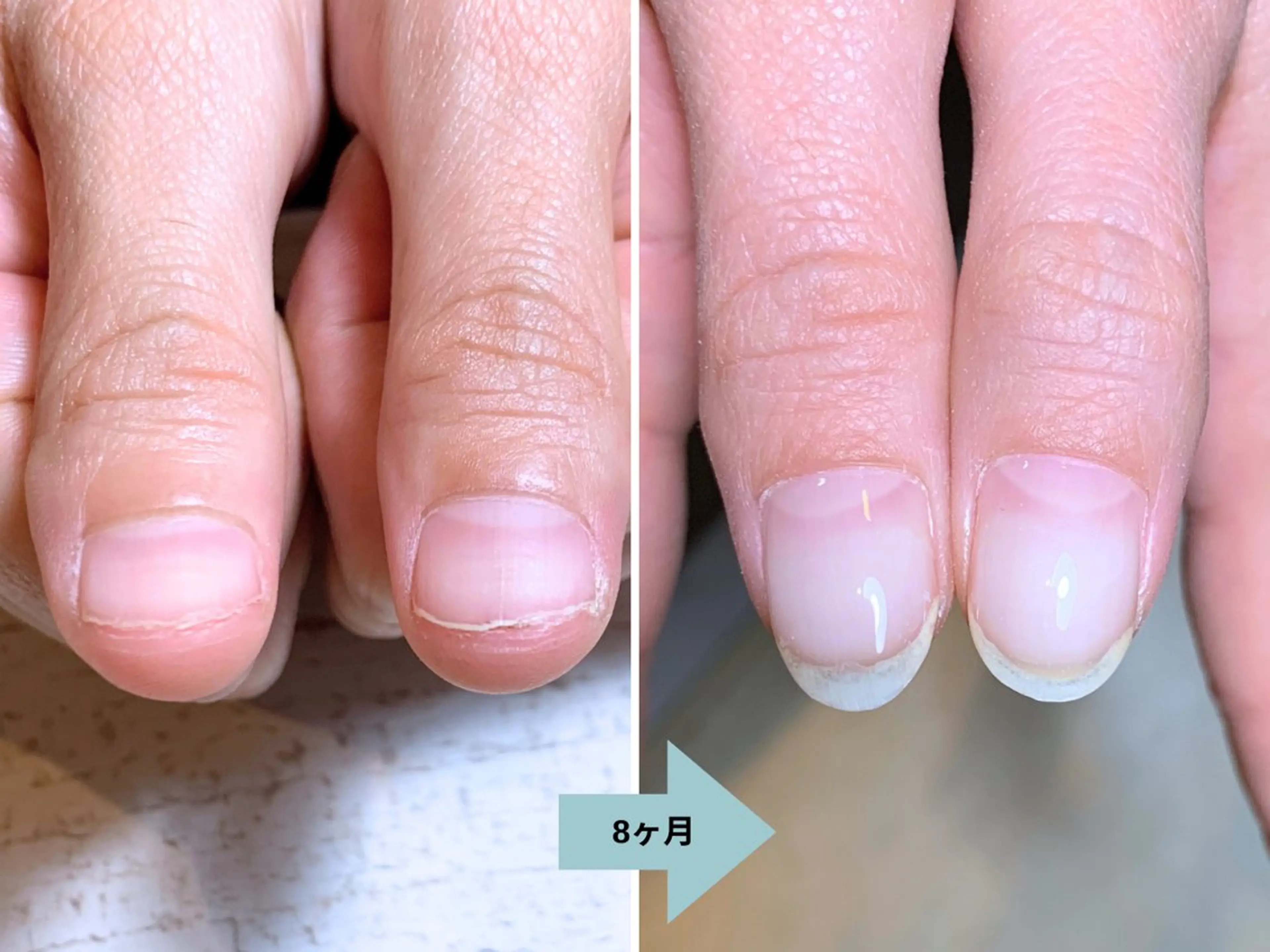 ネイル 深爪矯正・自爪育成 ネイルサロンアモここのネイルデザイン