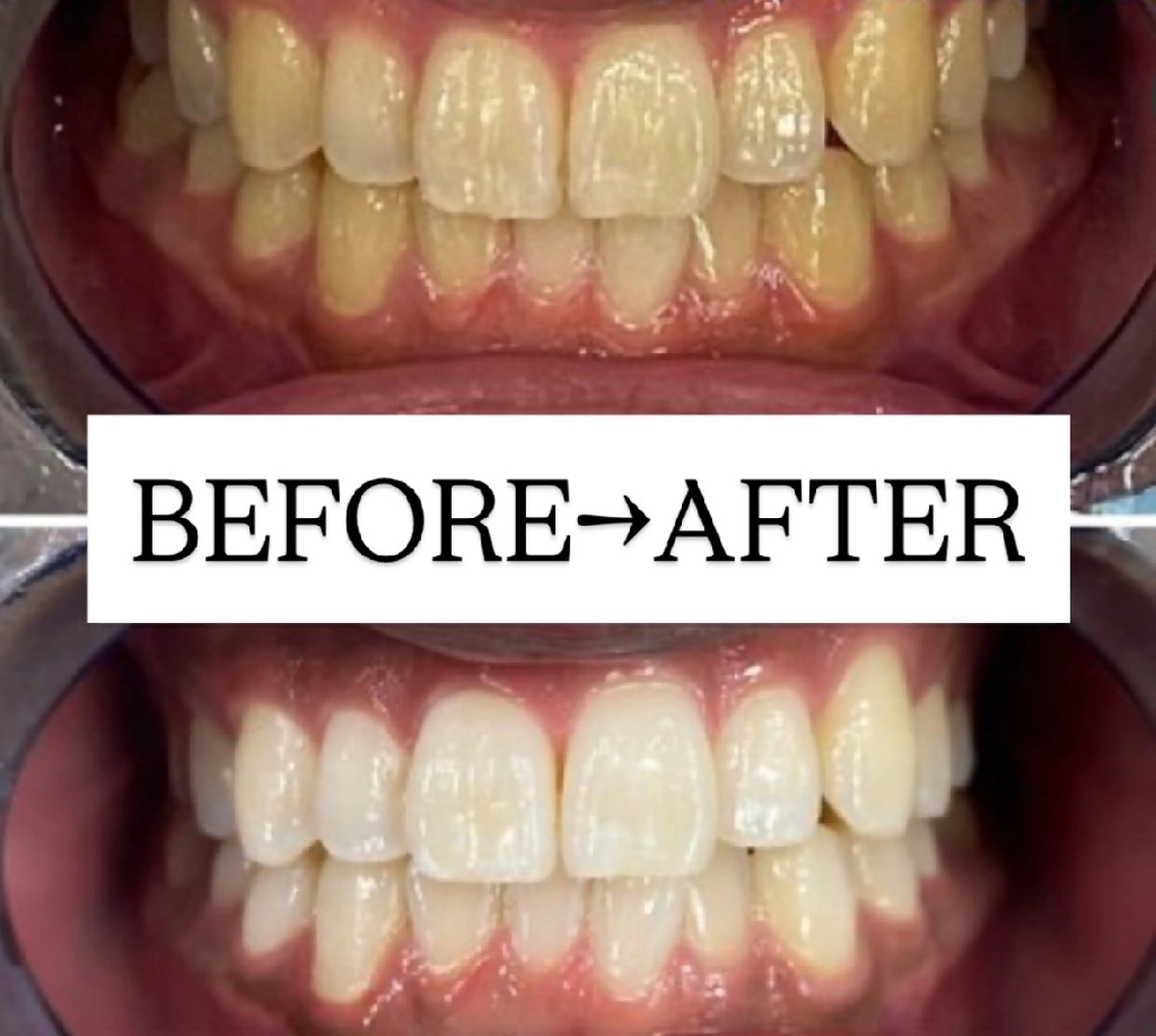 学割U24【お得な3回コース】美白ホワイトニング20分×6回 ¥13,200の写真