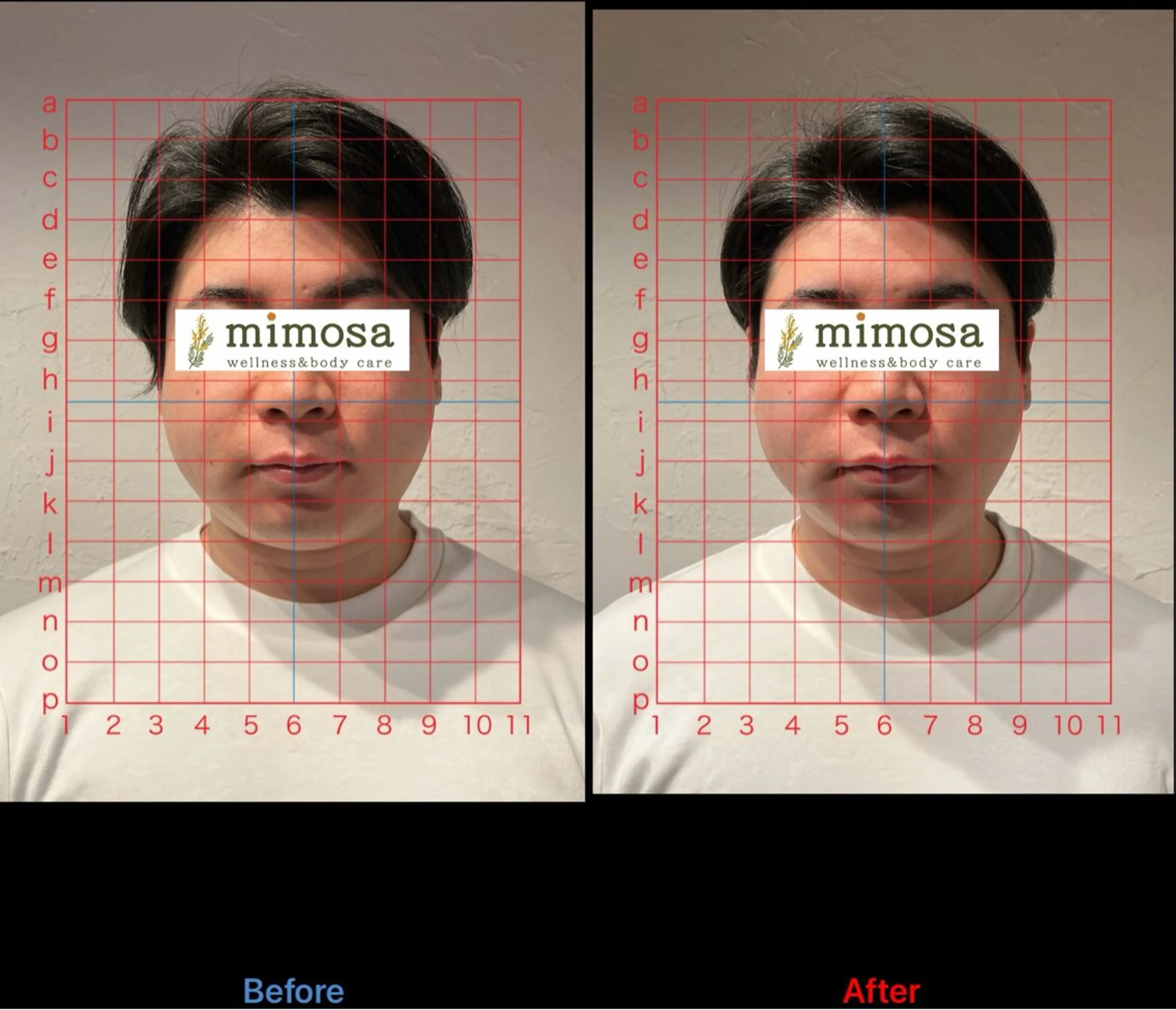 【モニター募集】顔の歪みが気になる方の写真