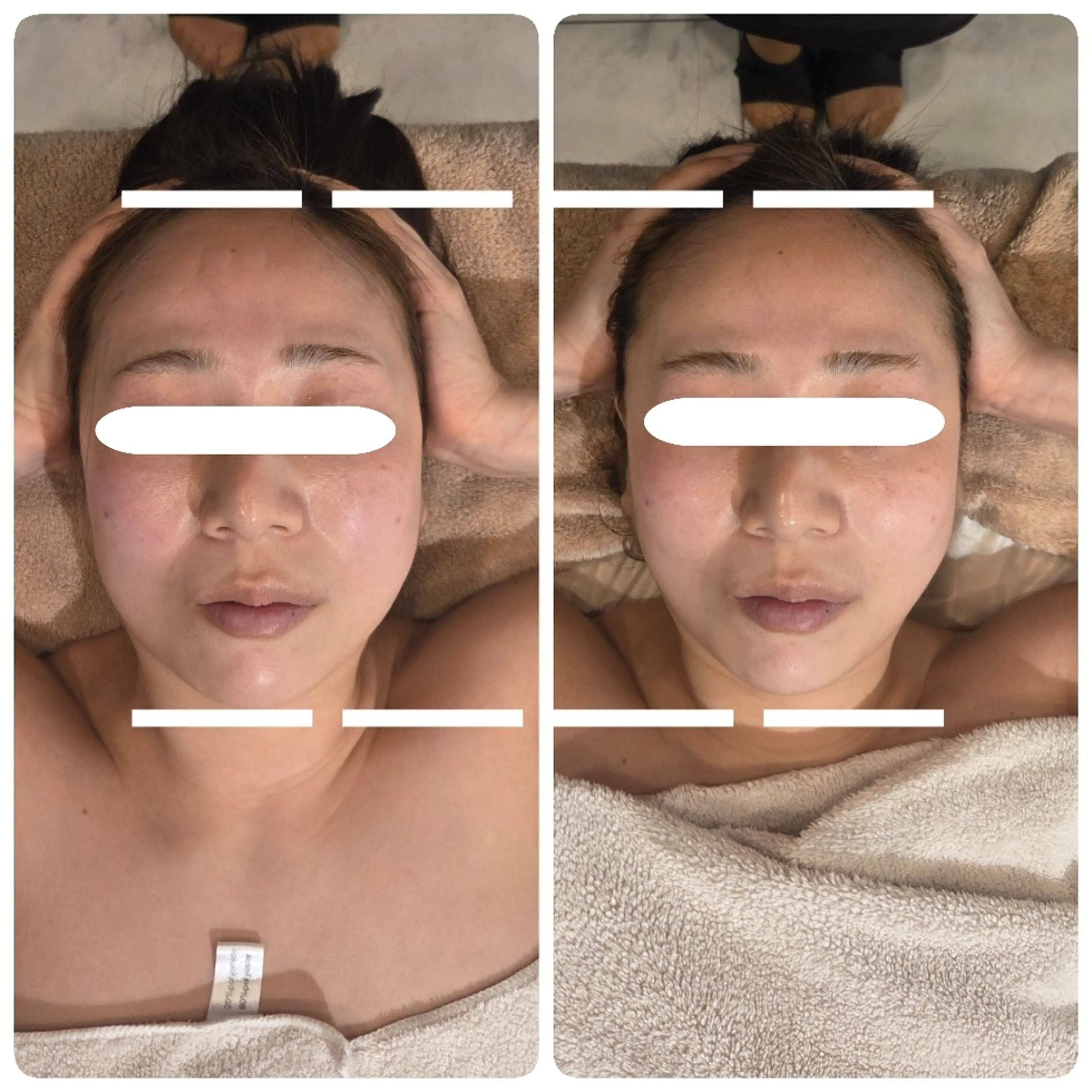 小顔フェイスリフトアップコース 2回目 ￥21,000の写真