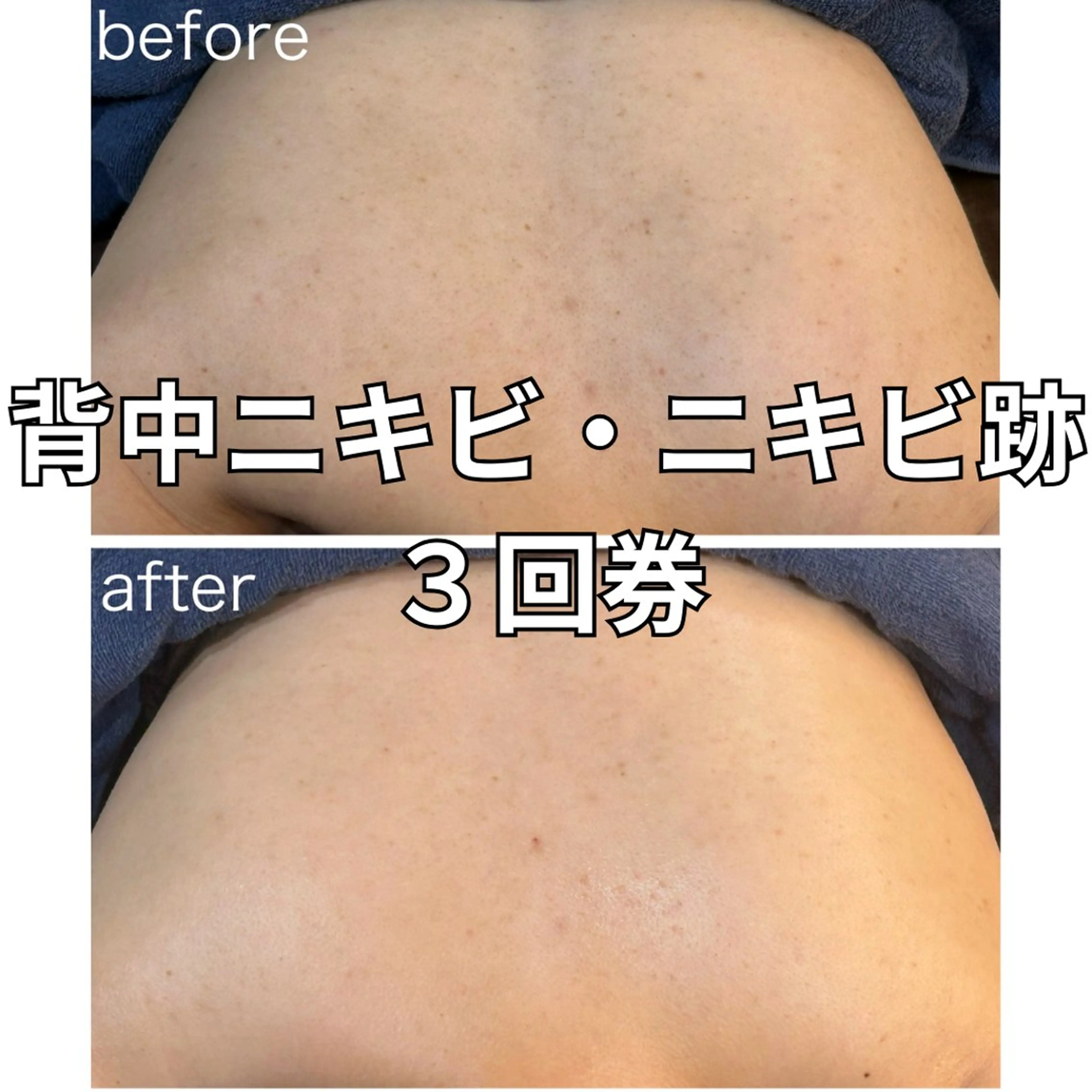 🌿背中ハーブピーリング3回集中コース🌿\ドレス姿に自信を✨ブライダルやイベント前の駆け込みケアに/の写真