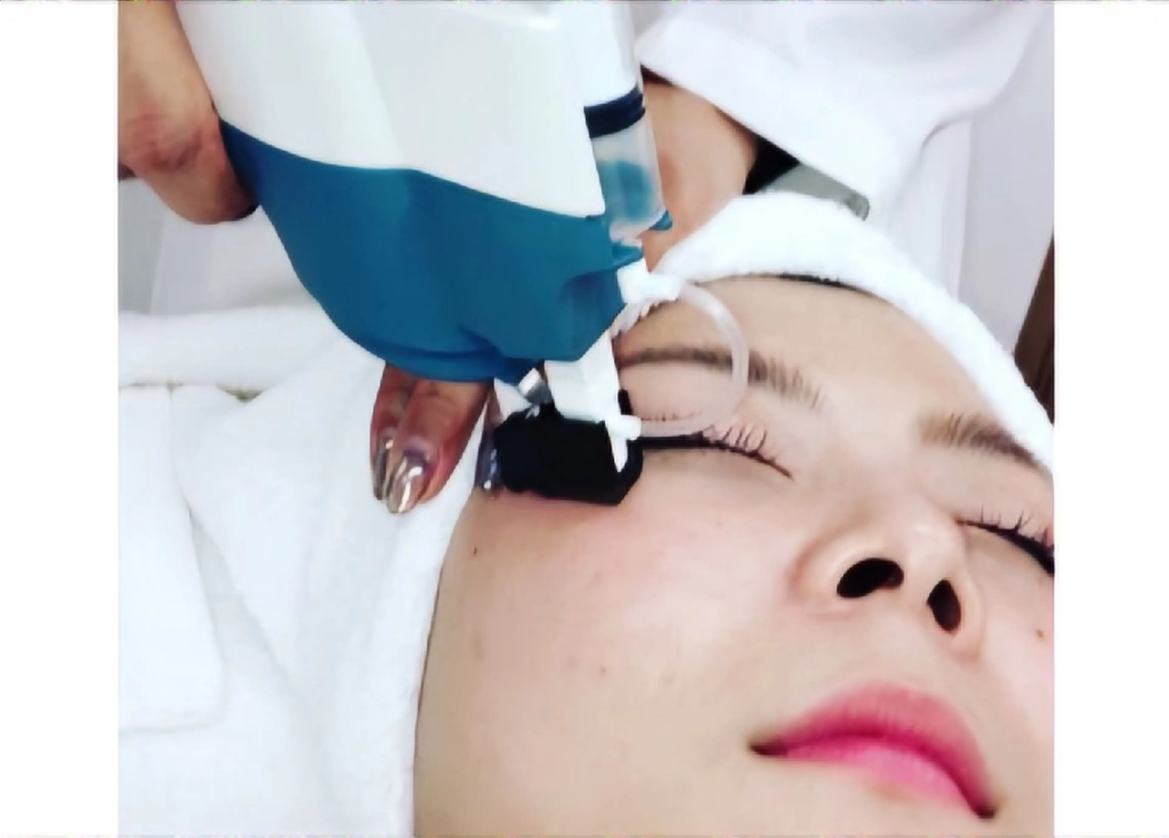 【フェイシャル人気No1】小顔コース《光フェイシャル×水光ジェット×炭酸×デコルテ》 "現金のみ"の写真