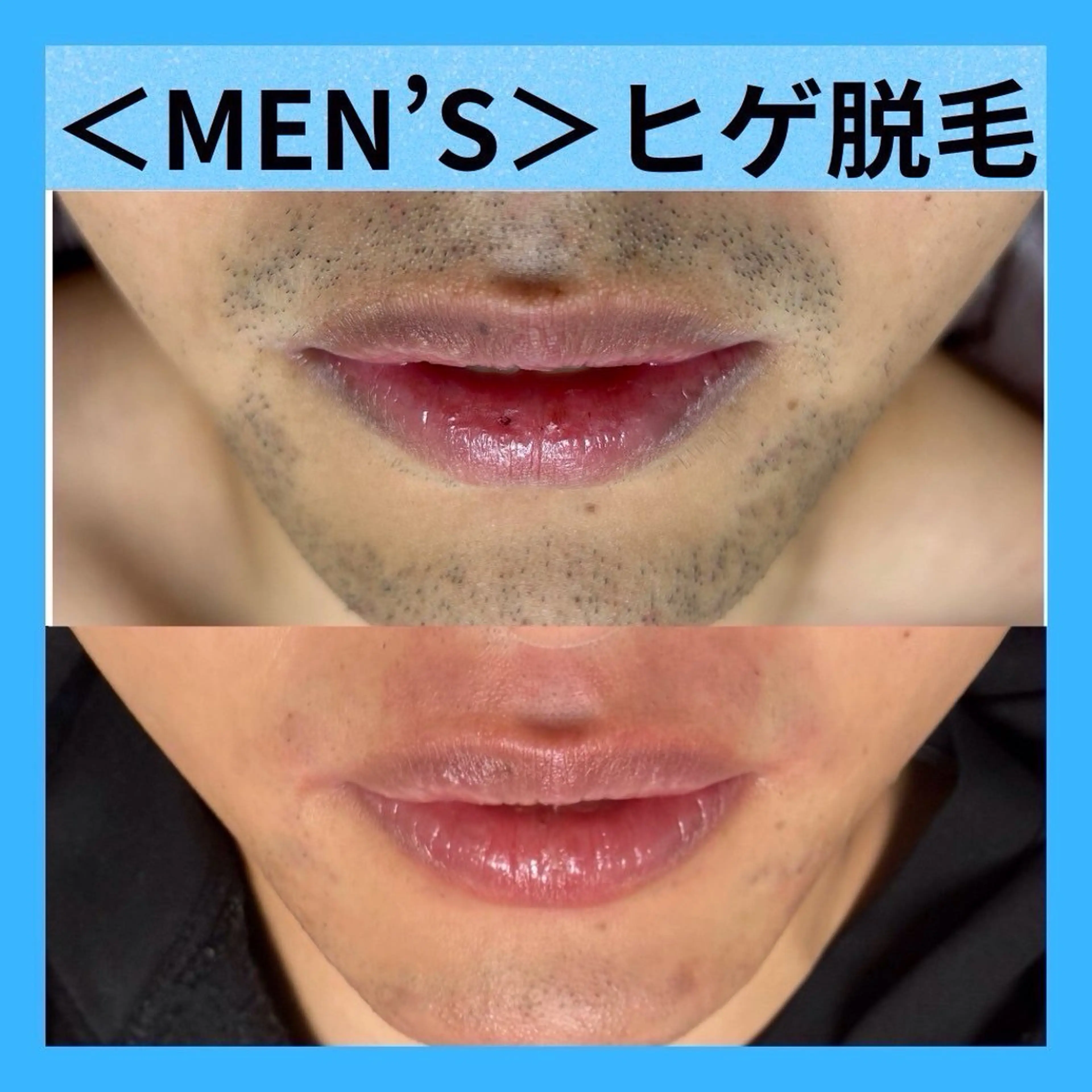【男性脱毛人気No.1】メンズヒゲ脱毛 面倒なヒゲ処理をstopの写真