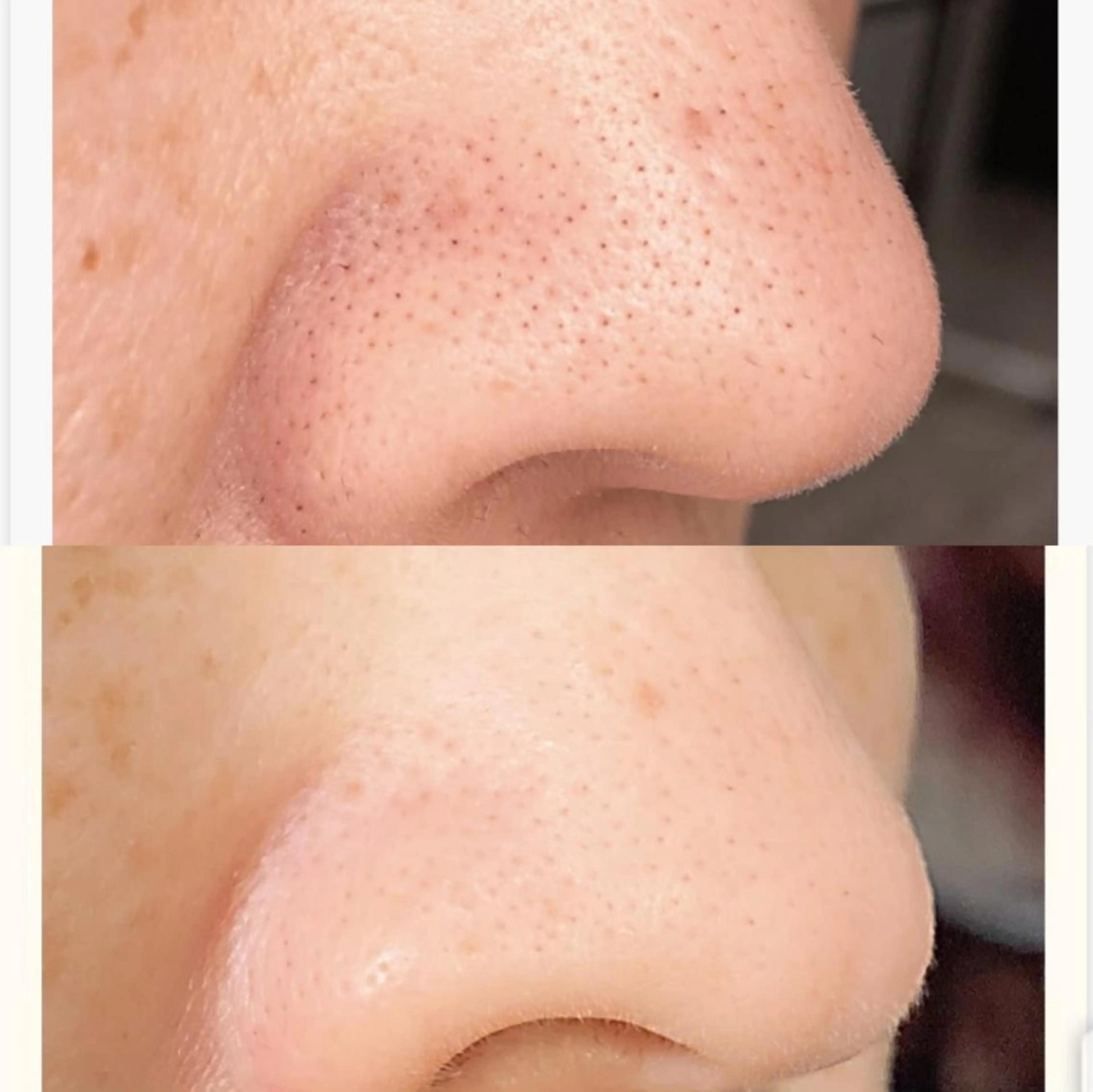 乳酸ピーリング＆毛穴洗浄全顔の写真