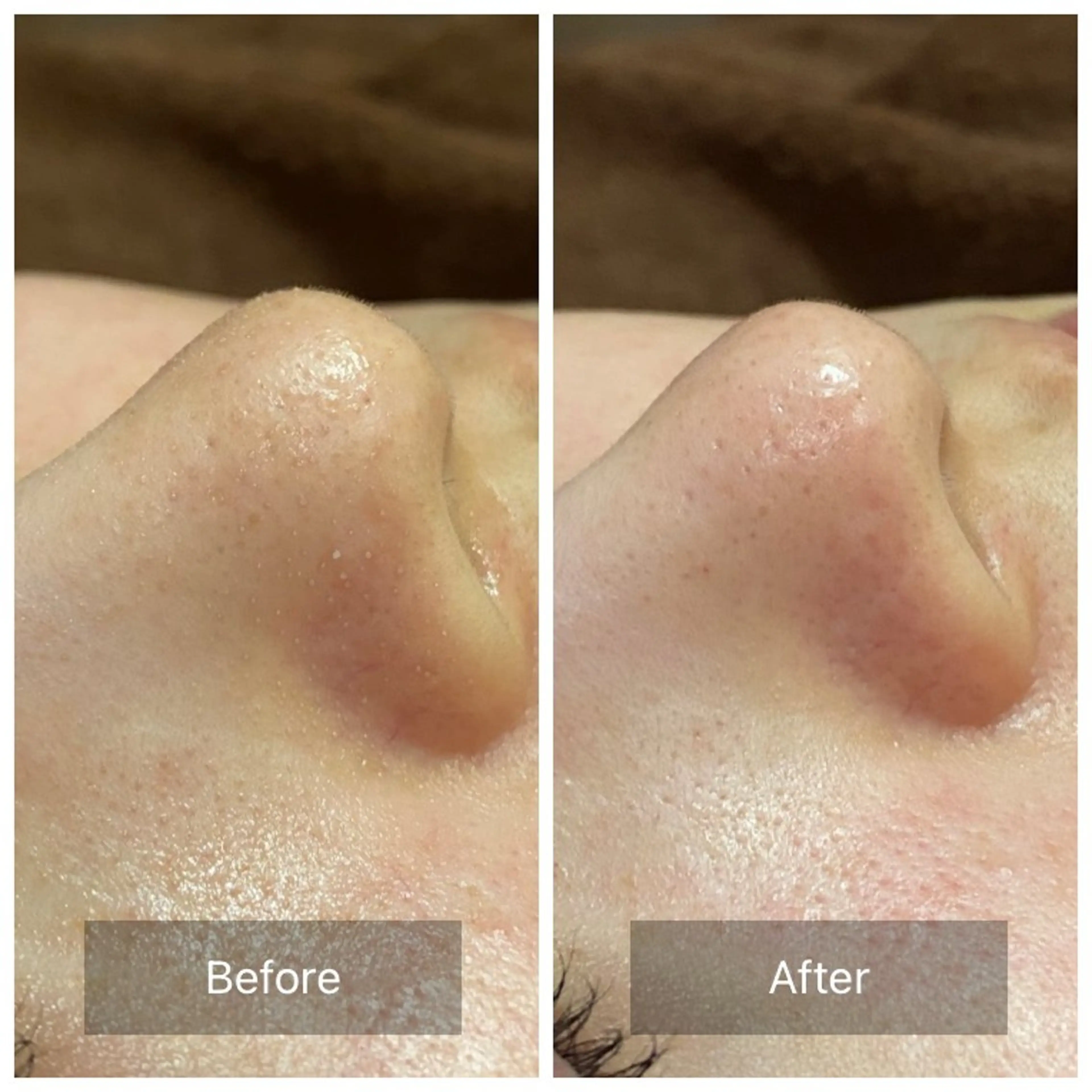 ハイドラフェイシャル　お試し　鼻の写真