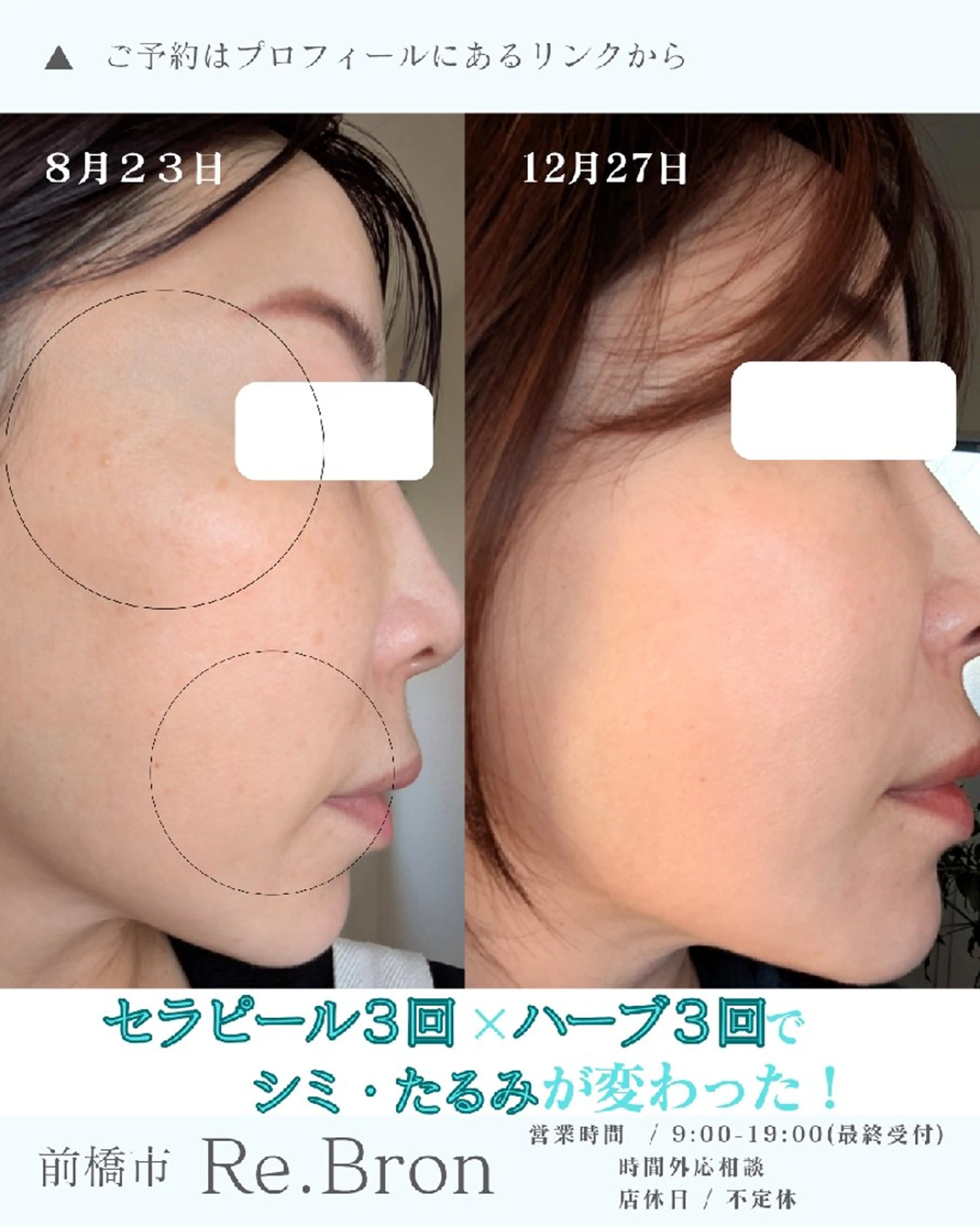 毛穴ケア くすみ肌 ハーブピーリングのエステ・リラクイメージ