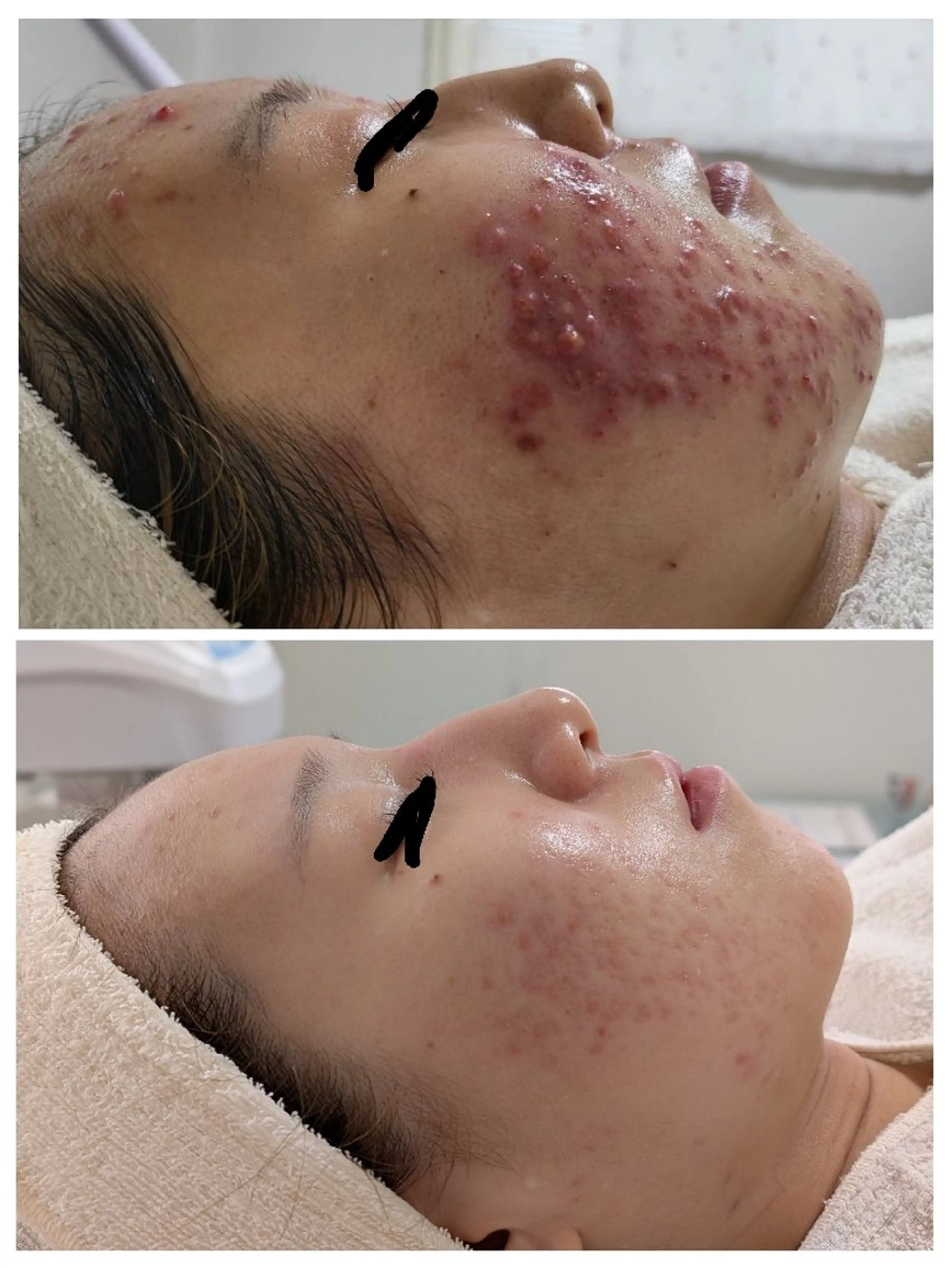 エステ レチノール/ニキビ/ 毛穴ケア　浅川のエステ・リラクイメージ