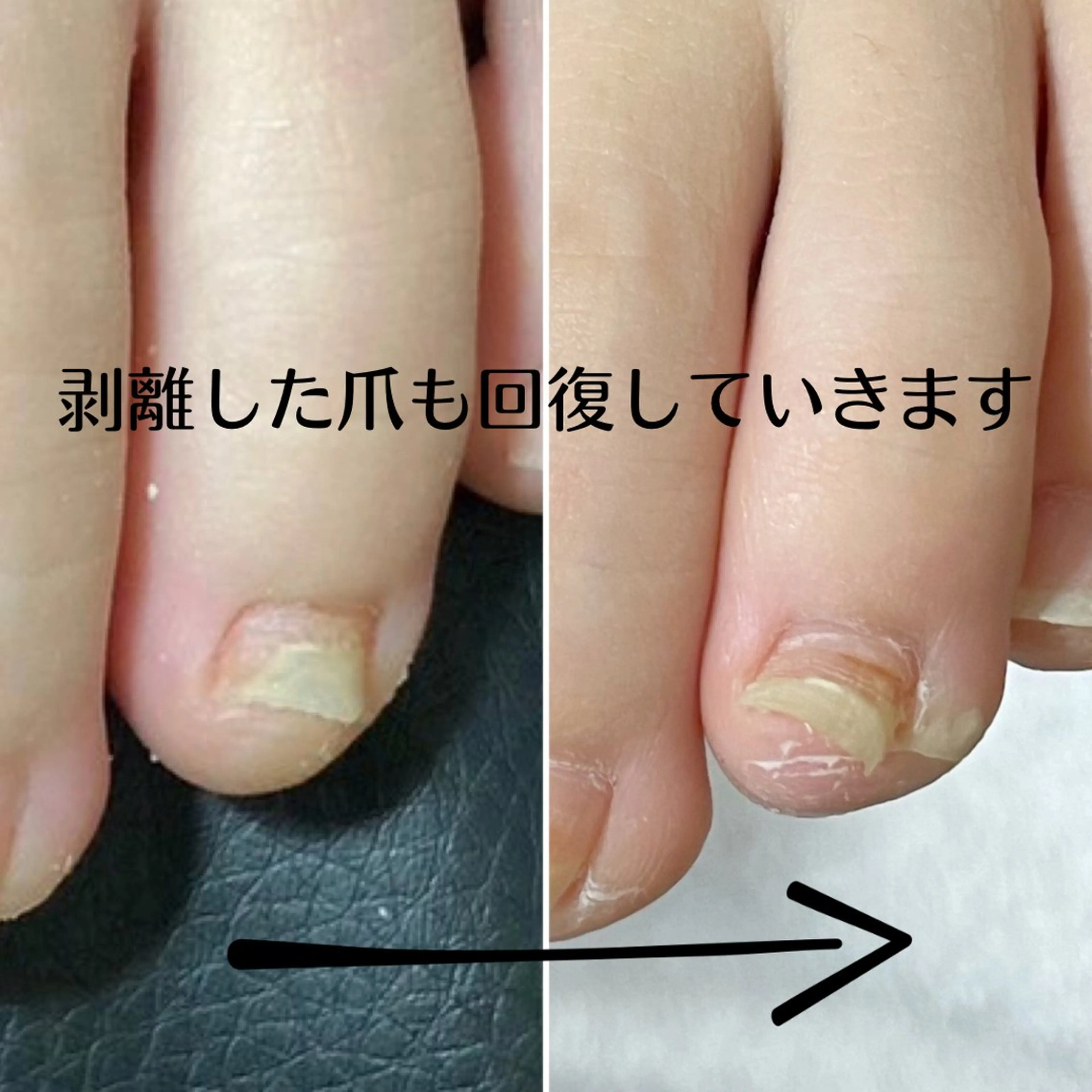 ネイル 深爪・巻き爪 専門サンセリテのネイルデザイン