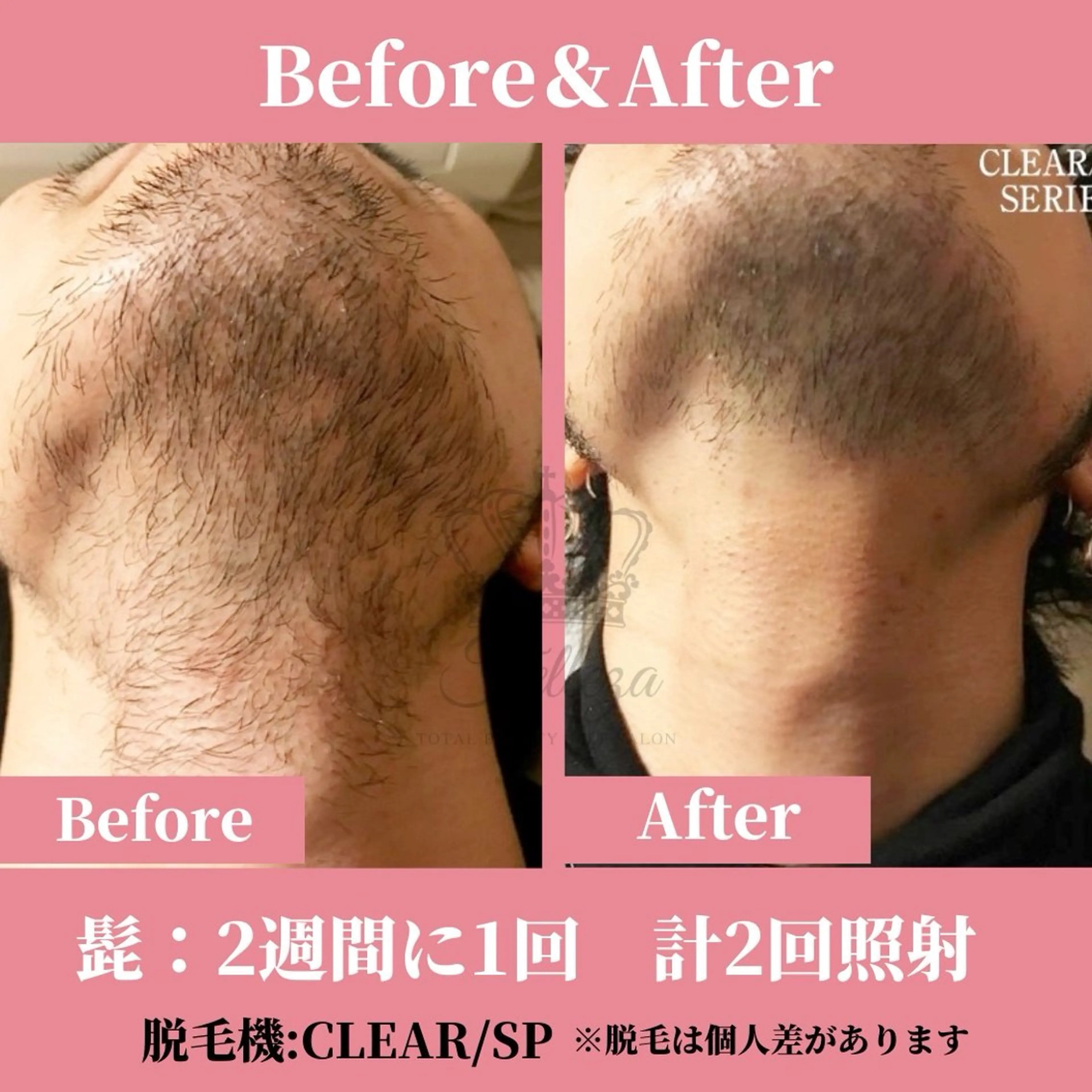 メンズ 有人型セルフサロン 脱毛/痩身/美顔のその他イメージ