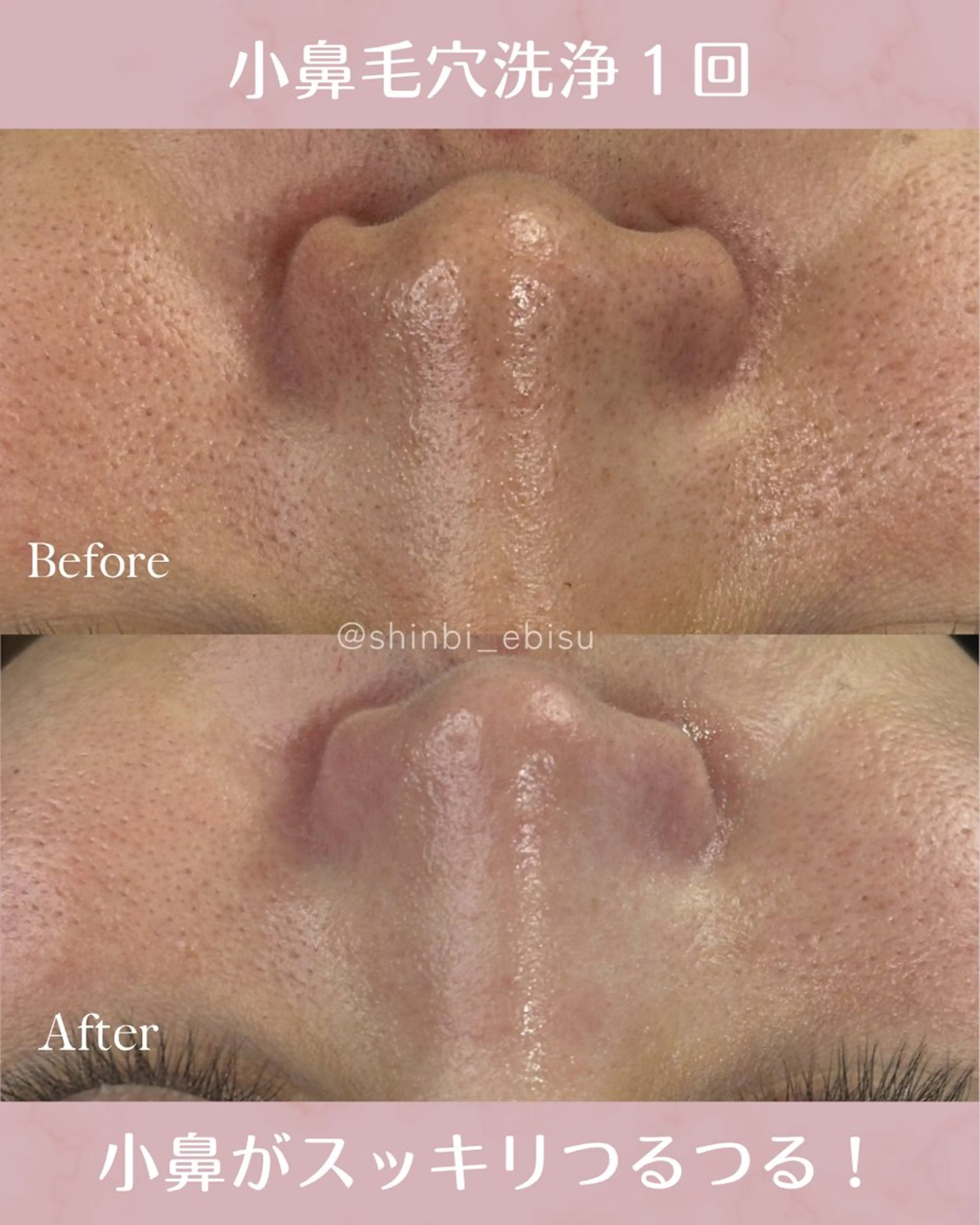 エステ 芯美-shinbi-所属・恵比寿フェイシャル ¦肌質改善¦えみのエステ・リラクイメージ